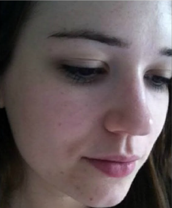 After Acne Treatment