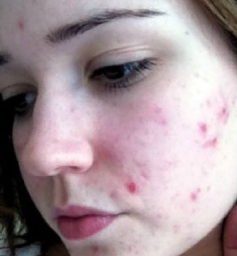 Before Acne Treatment