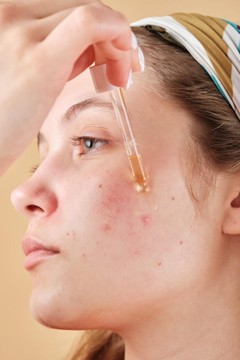 Clear skin after acne treatment