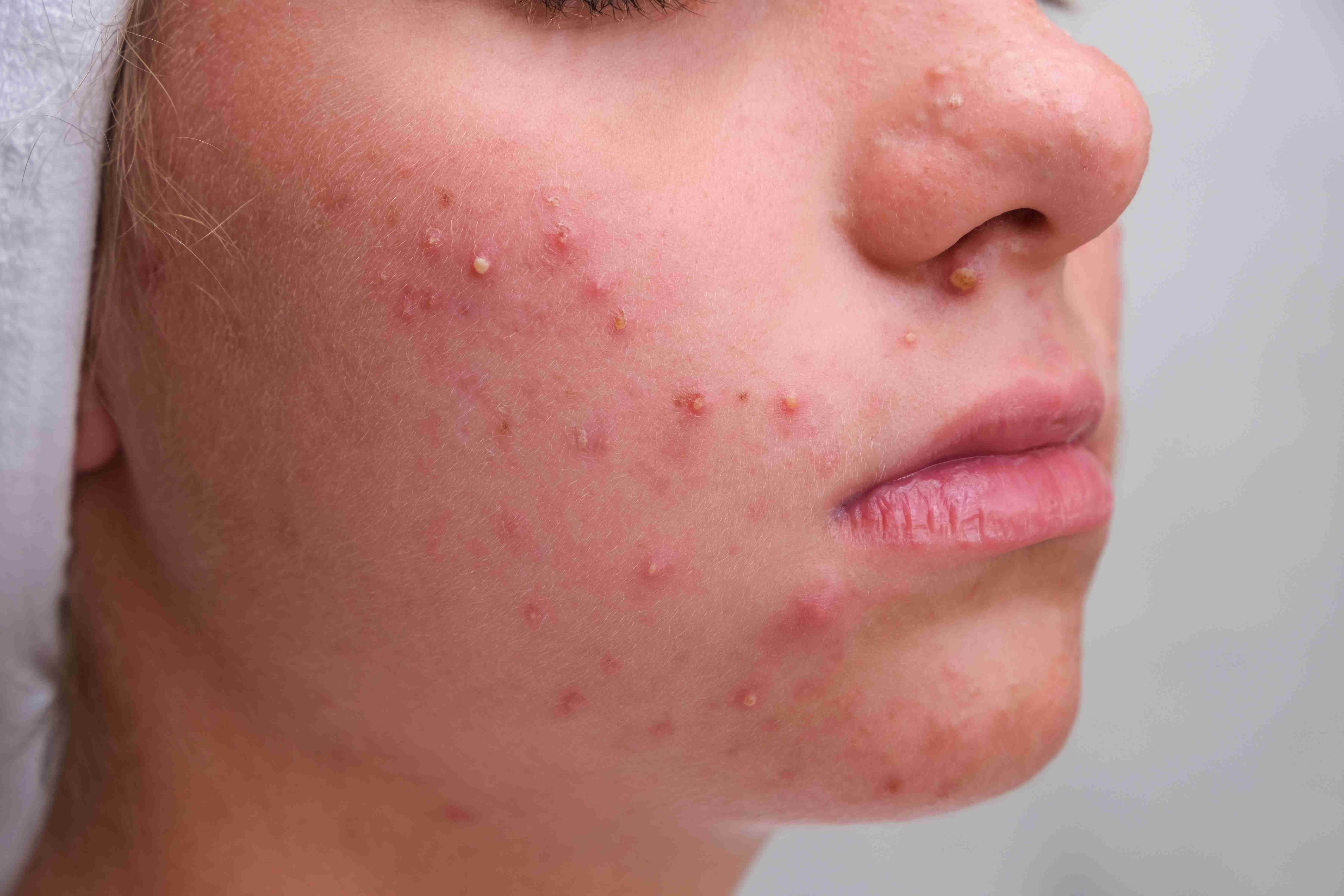 Types of acne on face