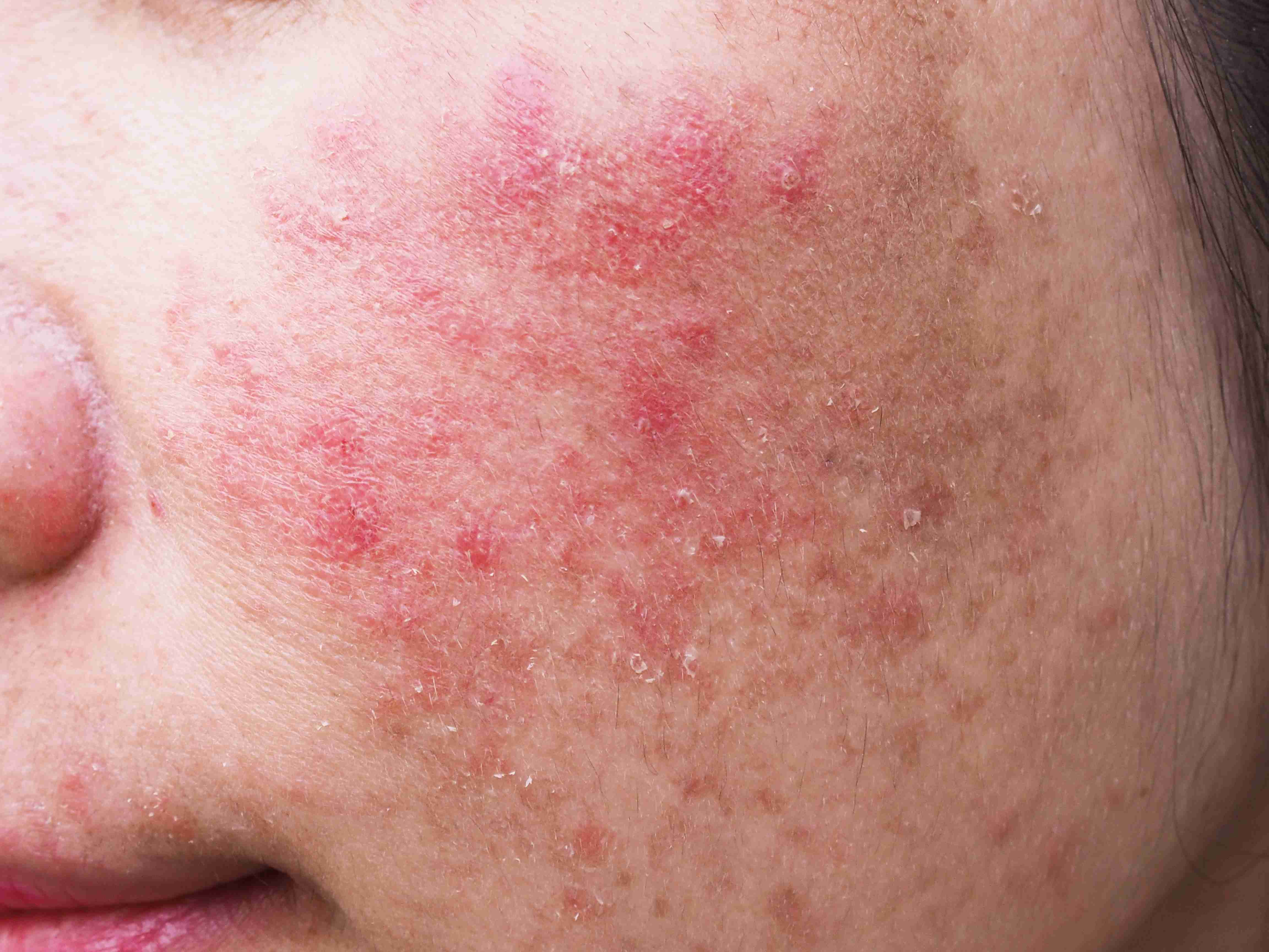 Acne types on cheek and back
