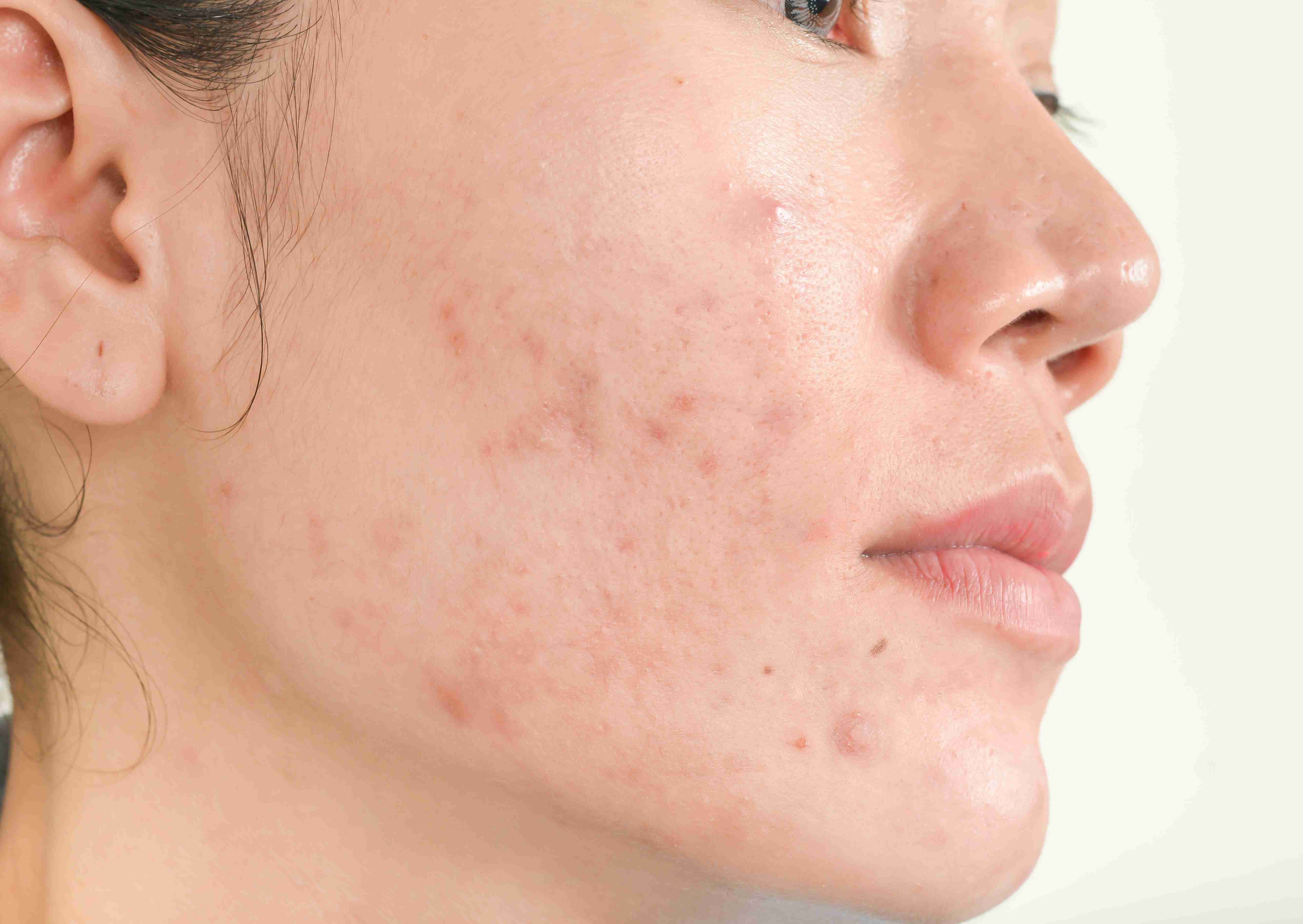 Acne treatment procedure