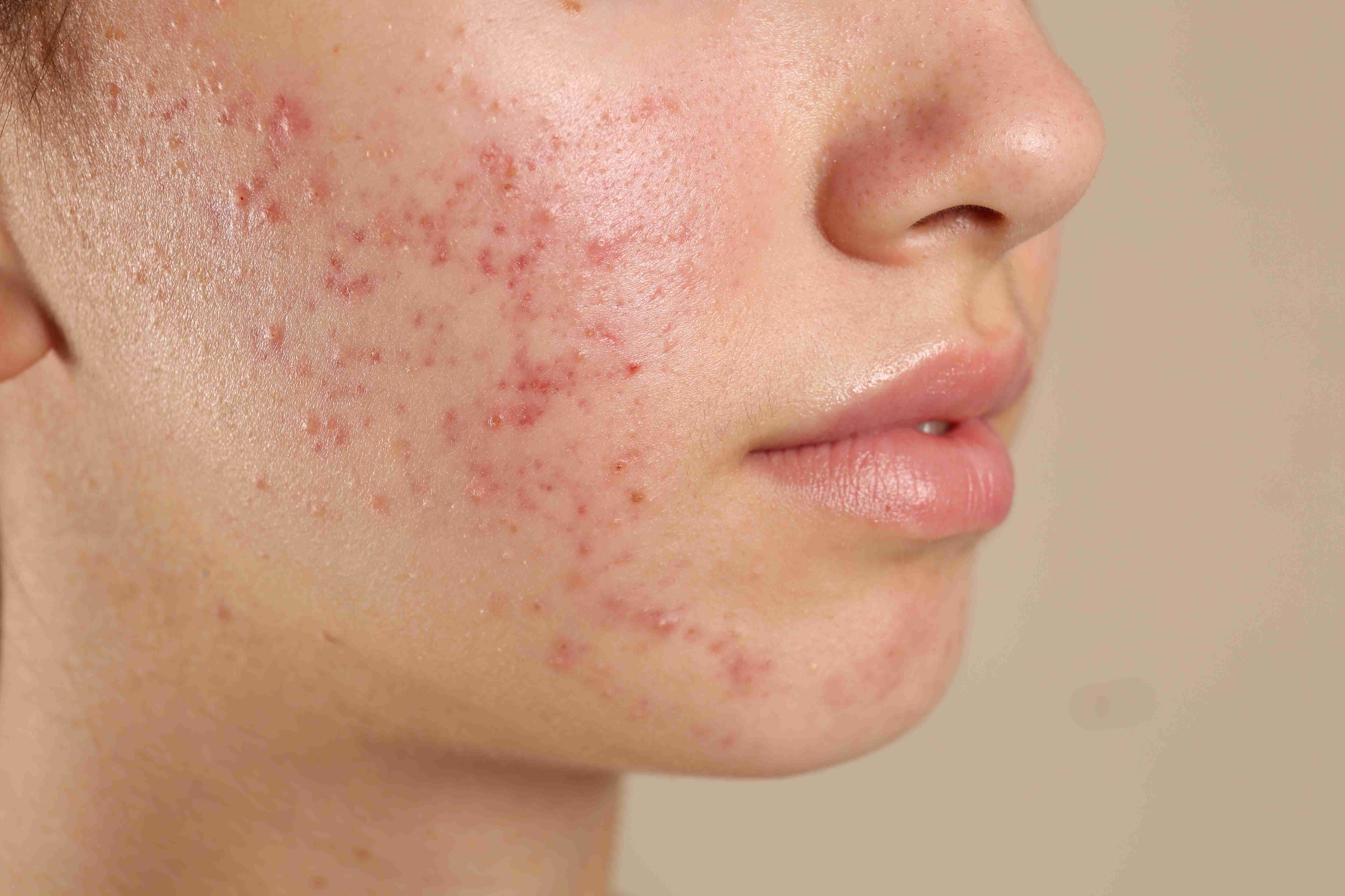 Clear skin after acne treatment