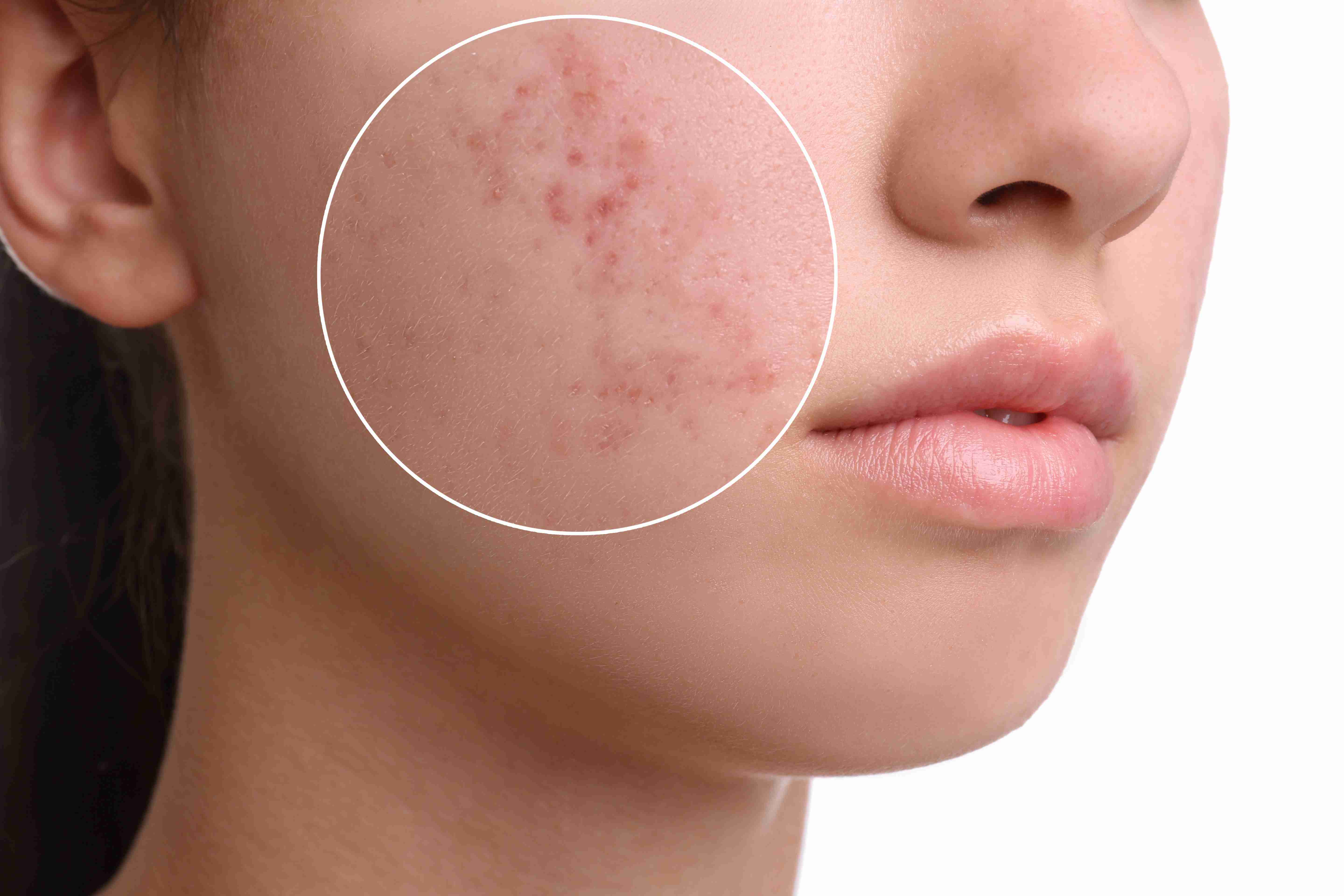 Dermatologist consultation for acne