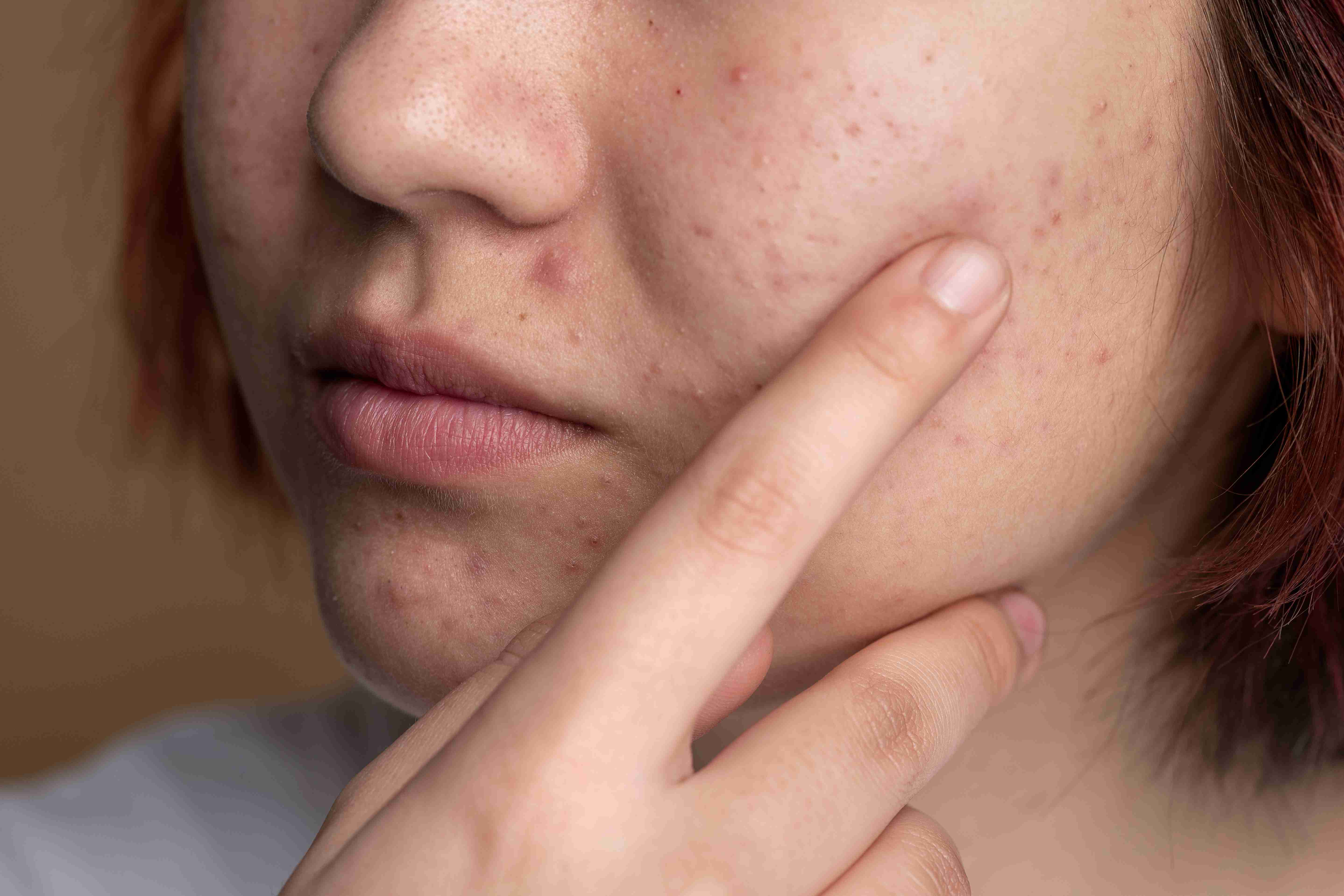Acne Scar Removal