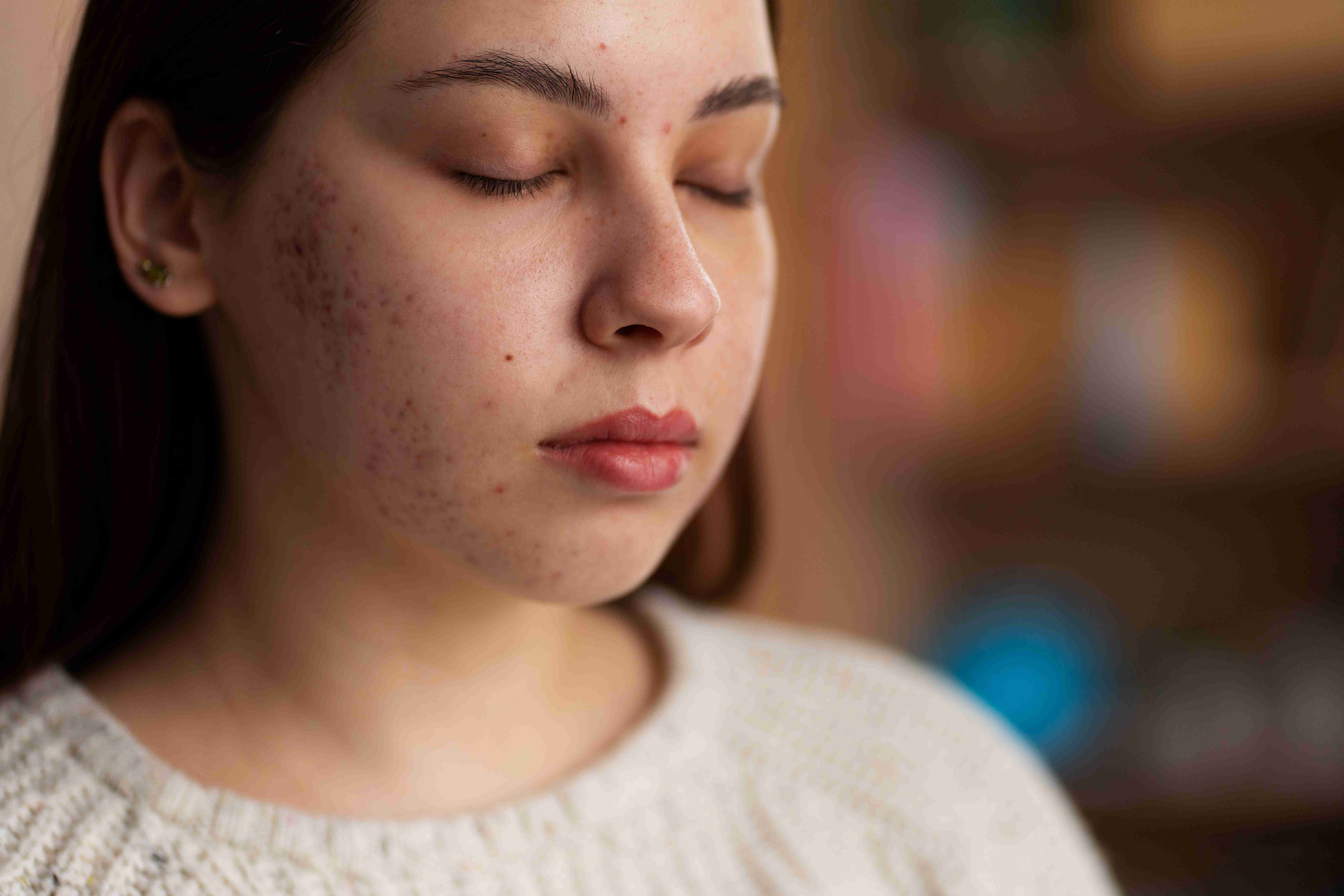 Scars after acne on cheek