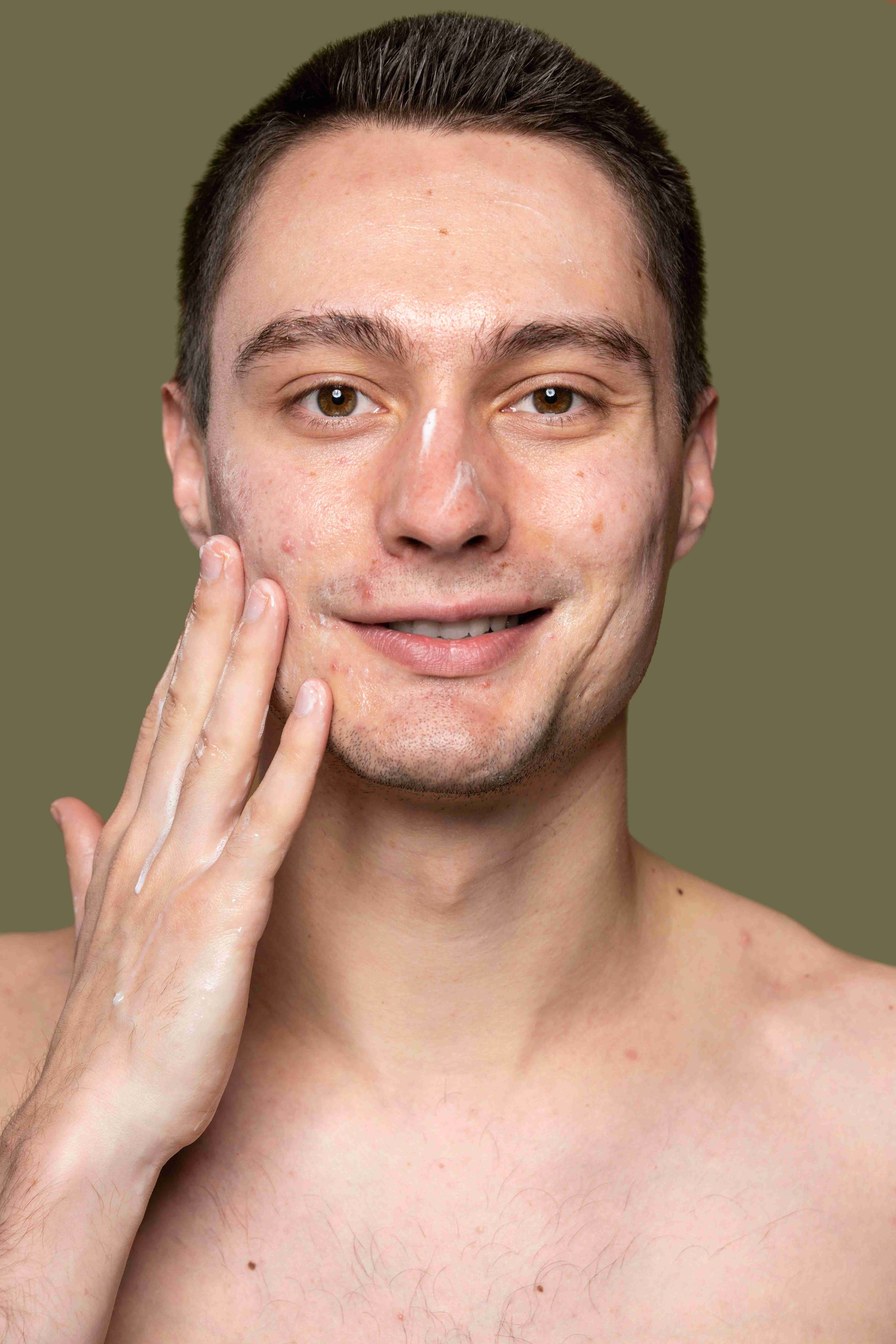 Laser and microneedling acne scar treatment