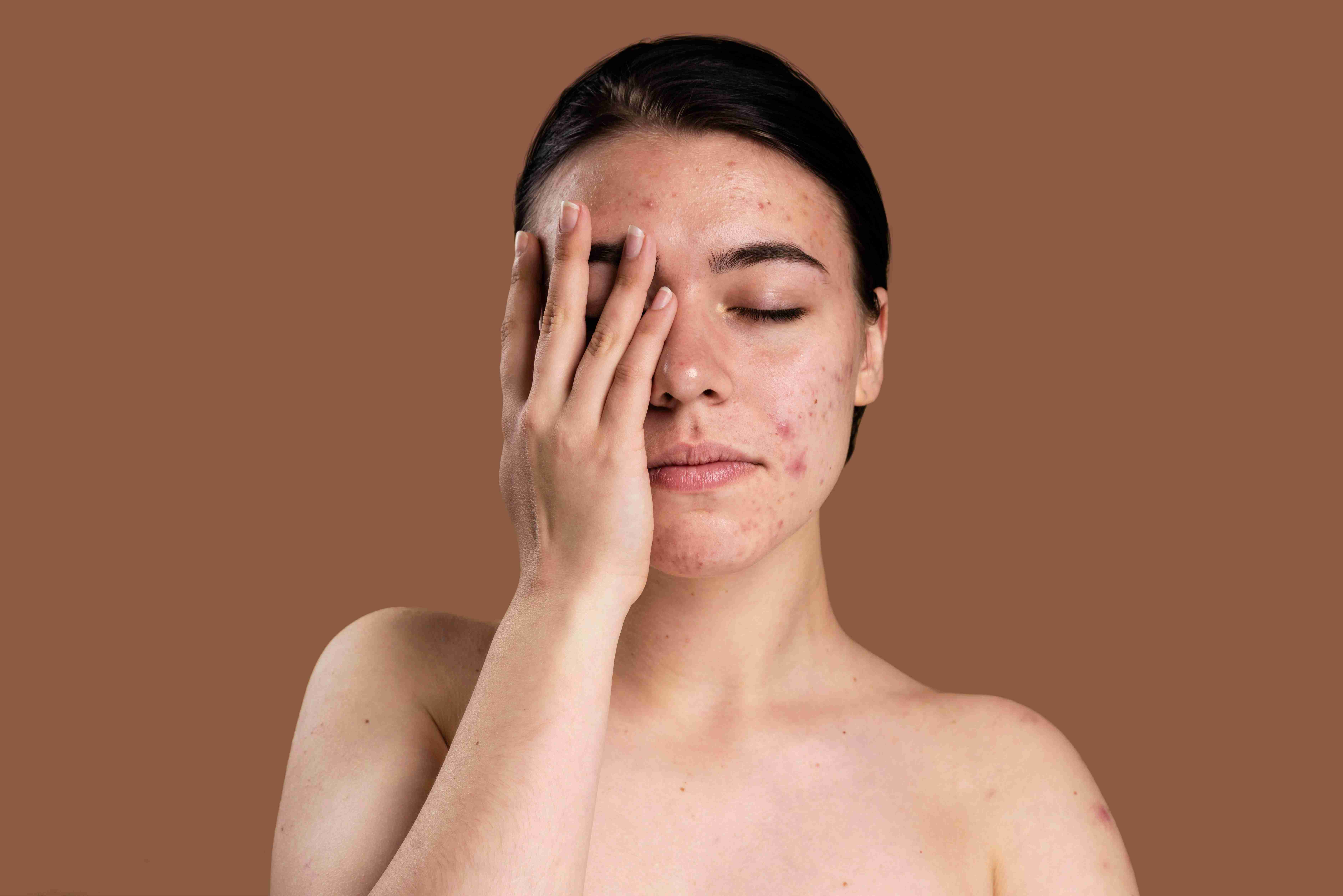 Before and after acne scar treatment