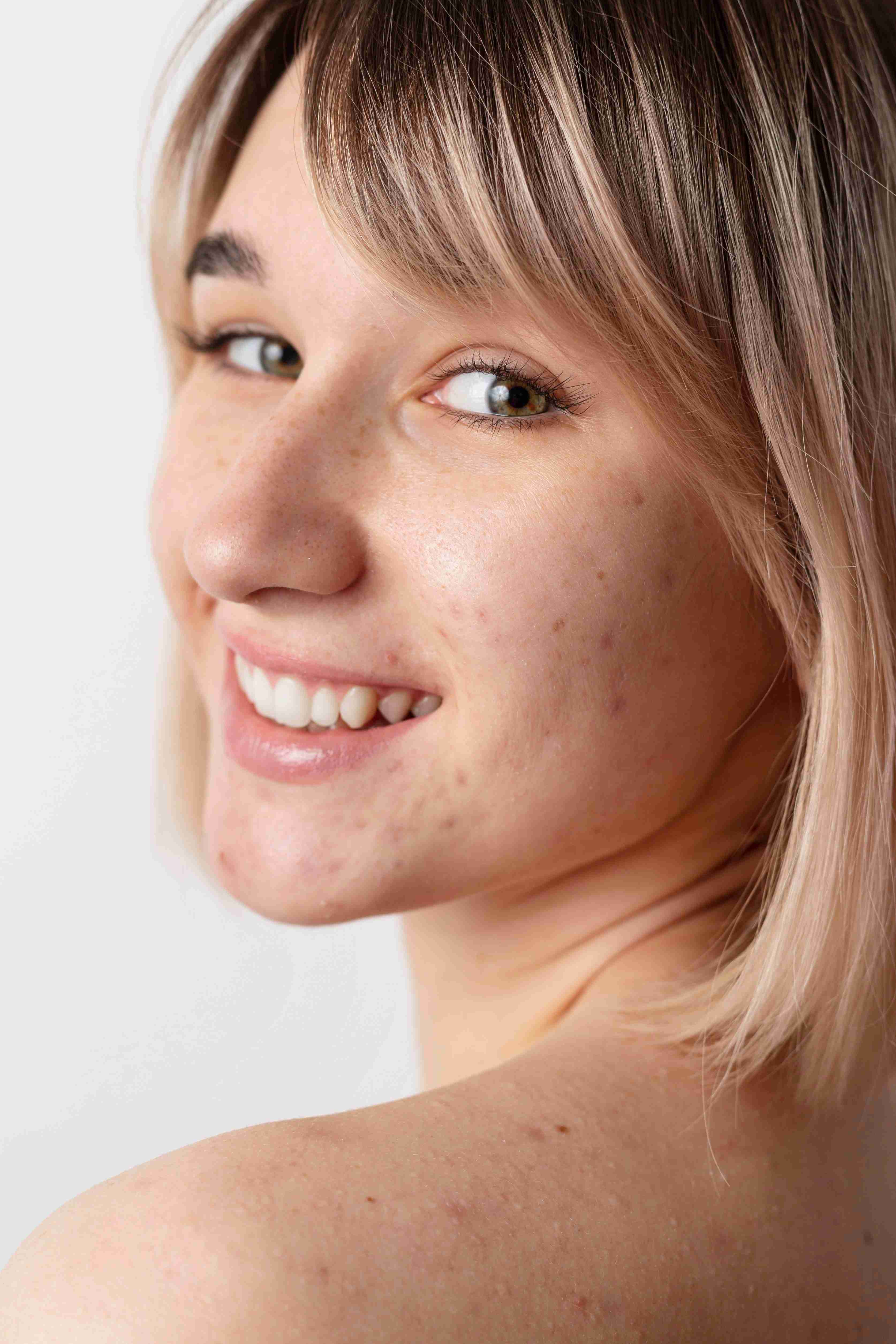 Dermatologist performing acne scar treatment