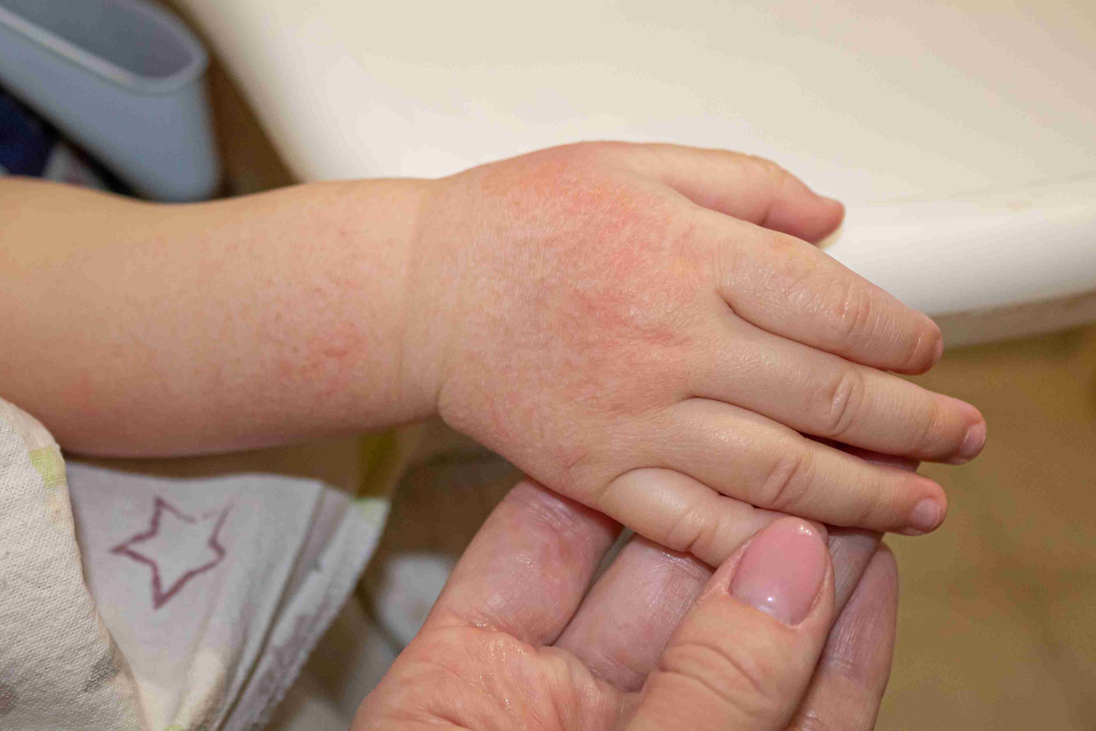 Itchy and inflamed skin in atopic dermatitis