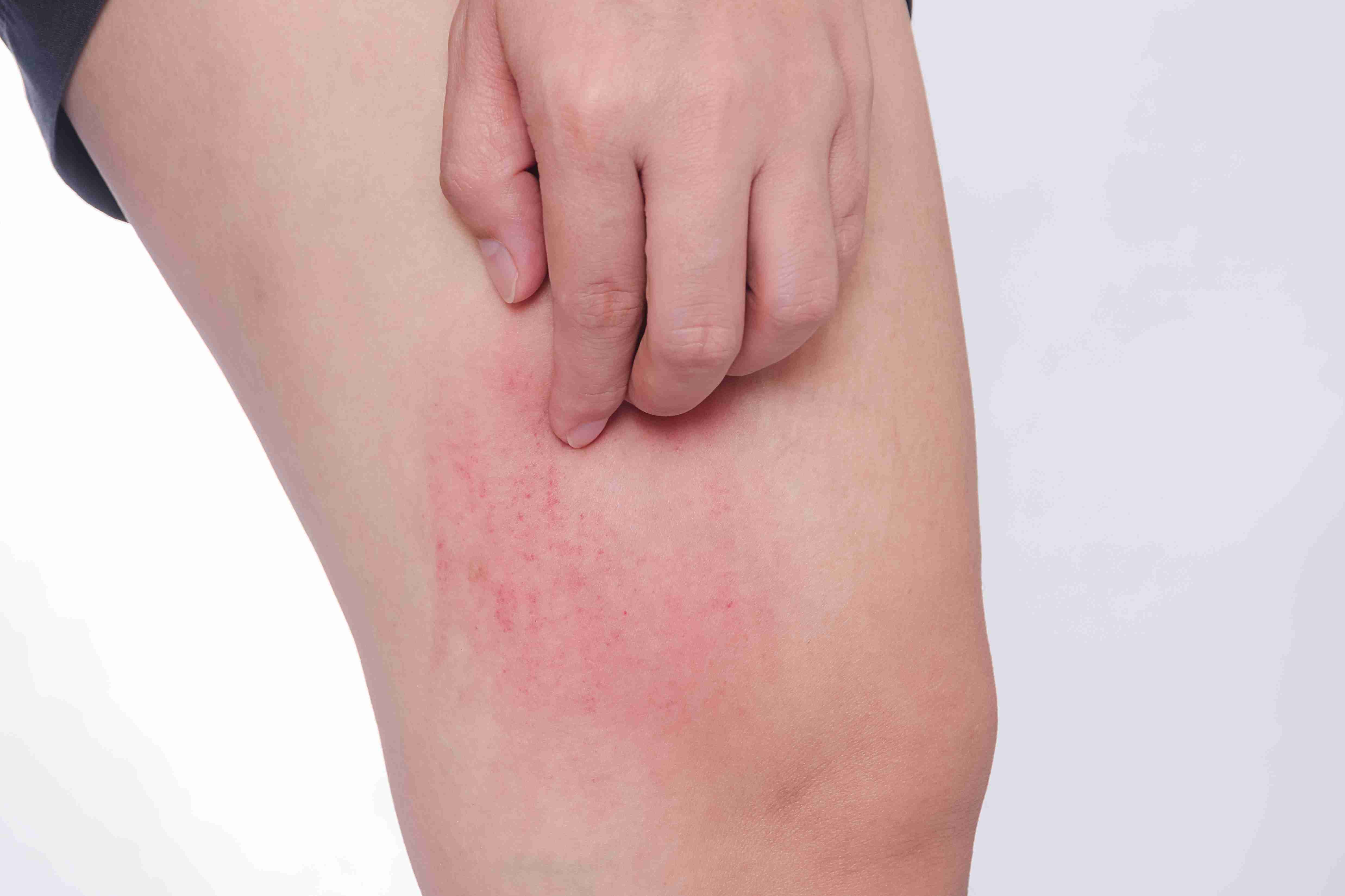 Dry, itchy and inflamed skin