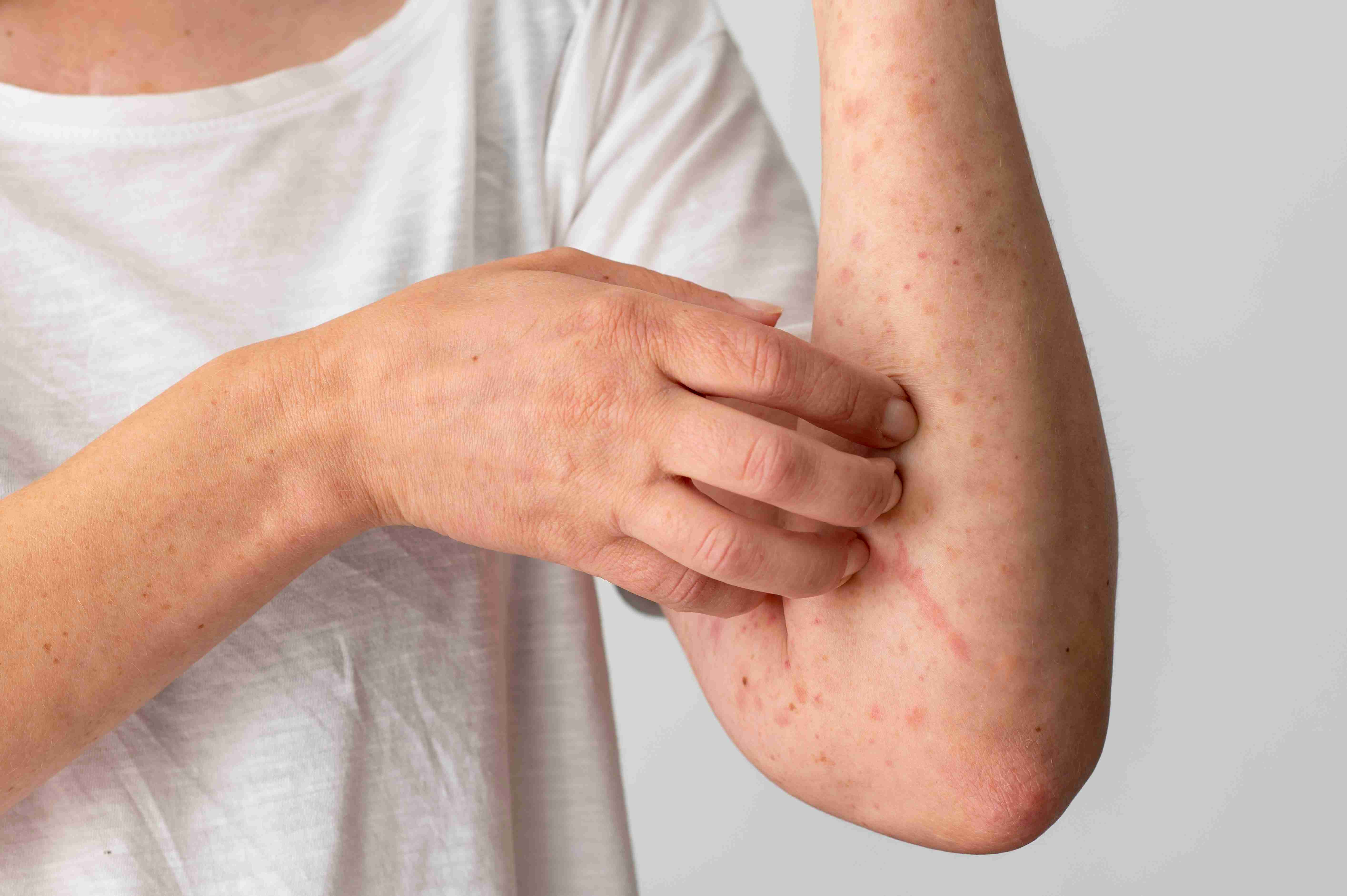 Moisturizing atopic skin