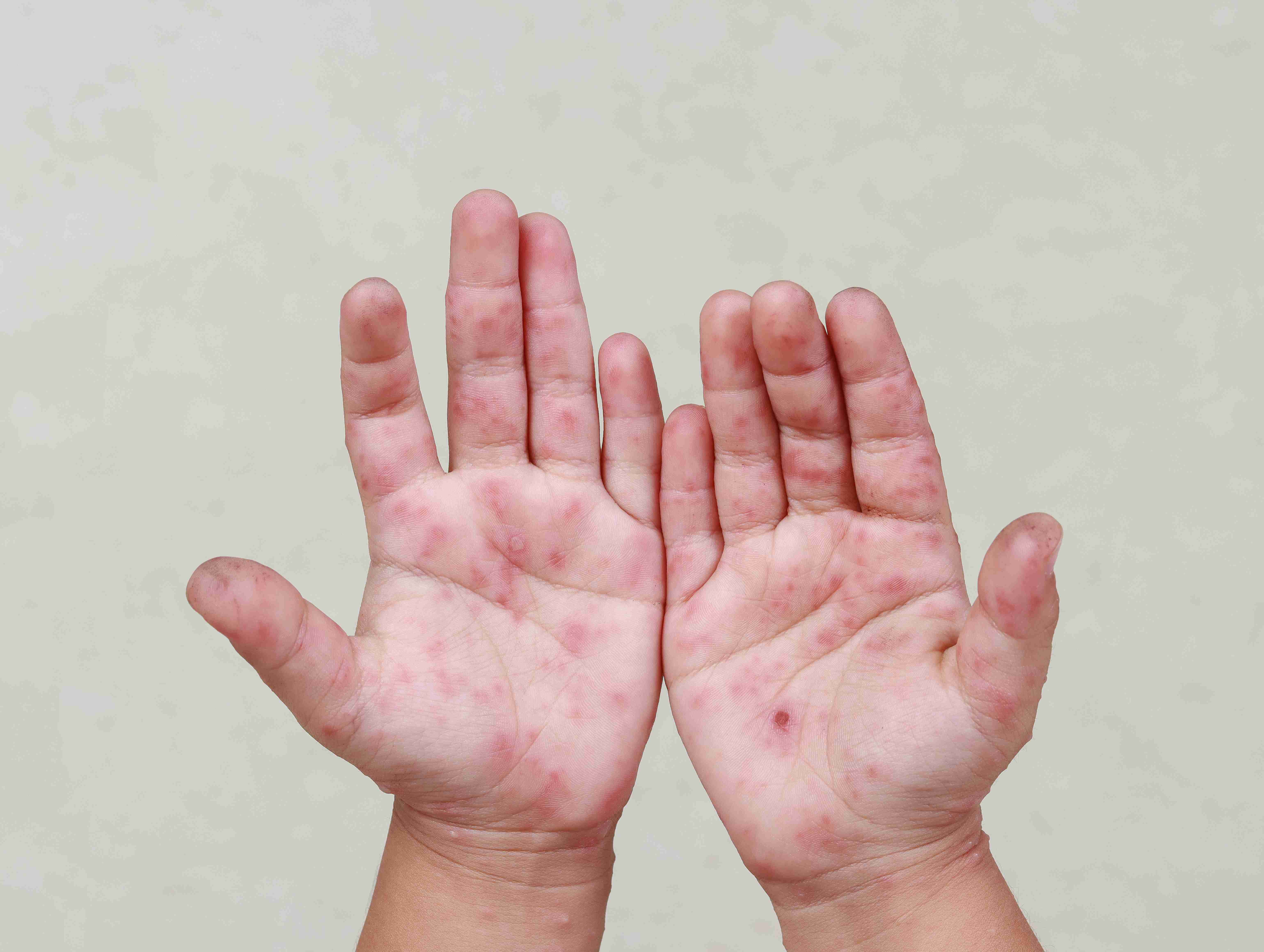 Atopic dermatitis on the back of the hand