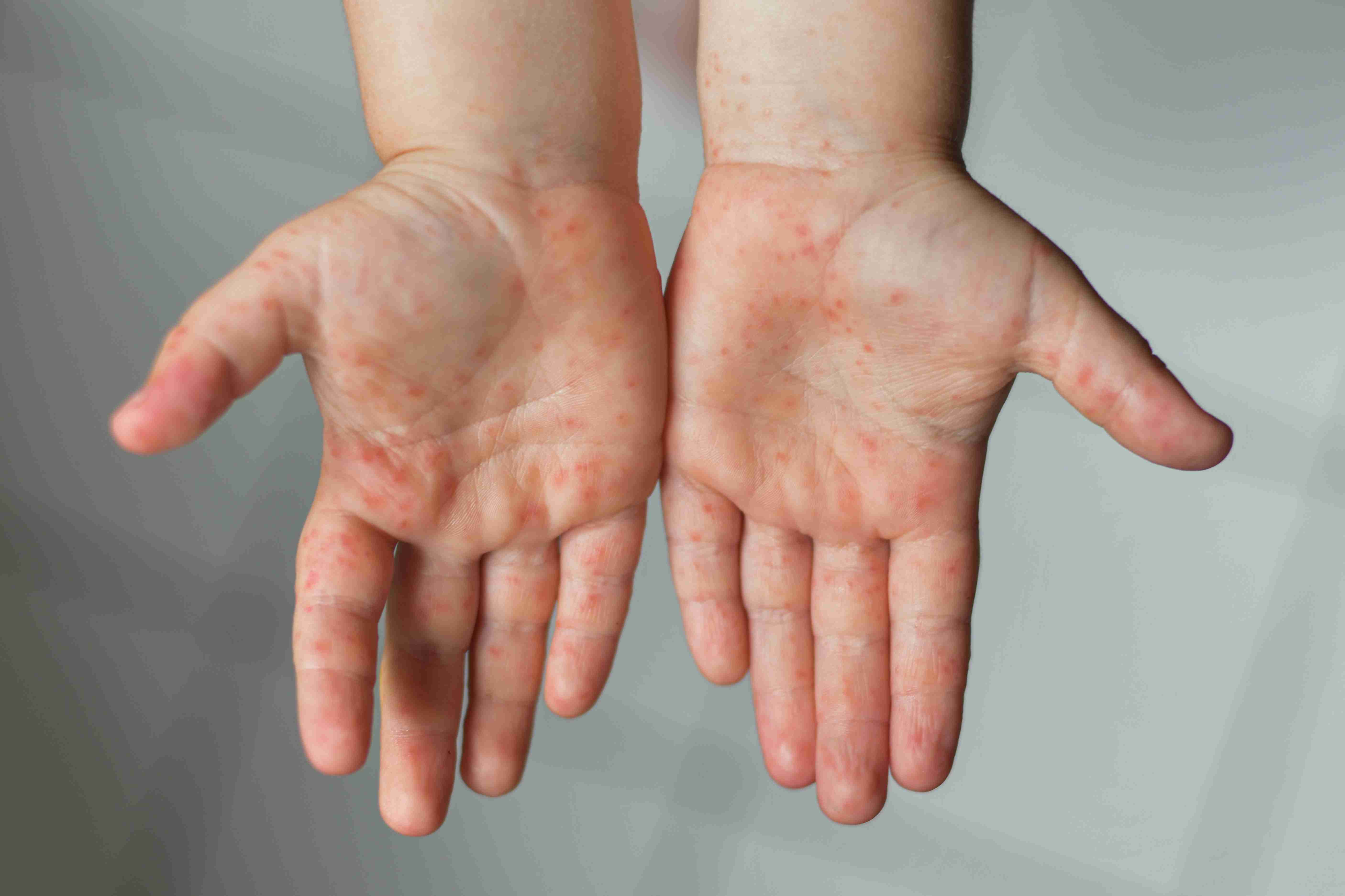 Before and after atopic dermatitis treatment