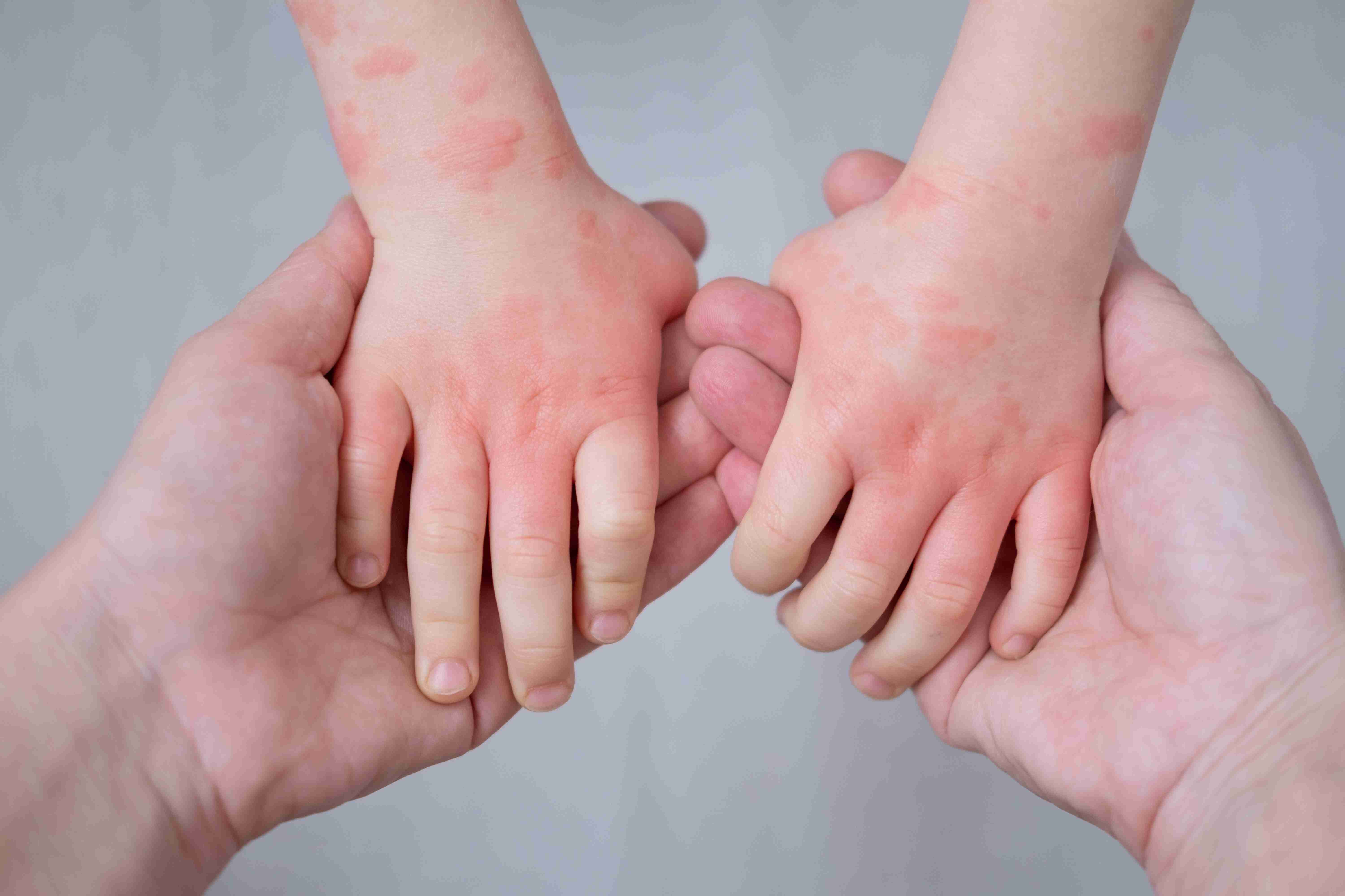 Red itchy rash due to contact dermatitis