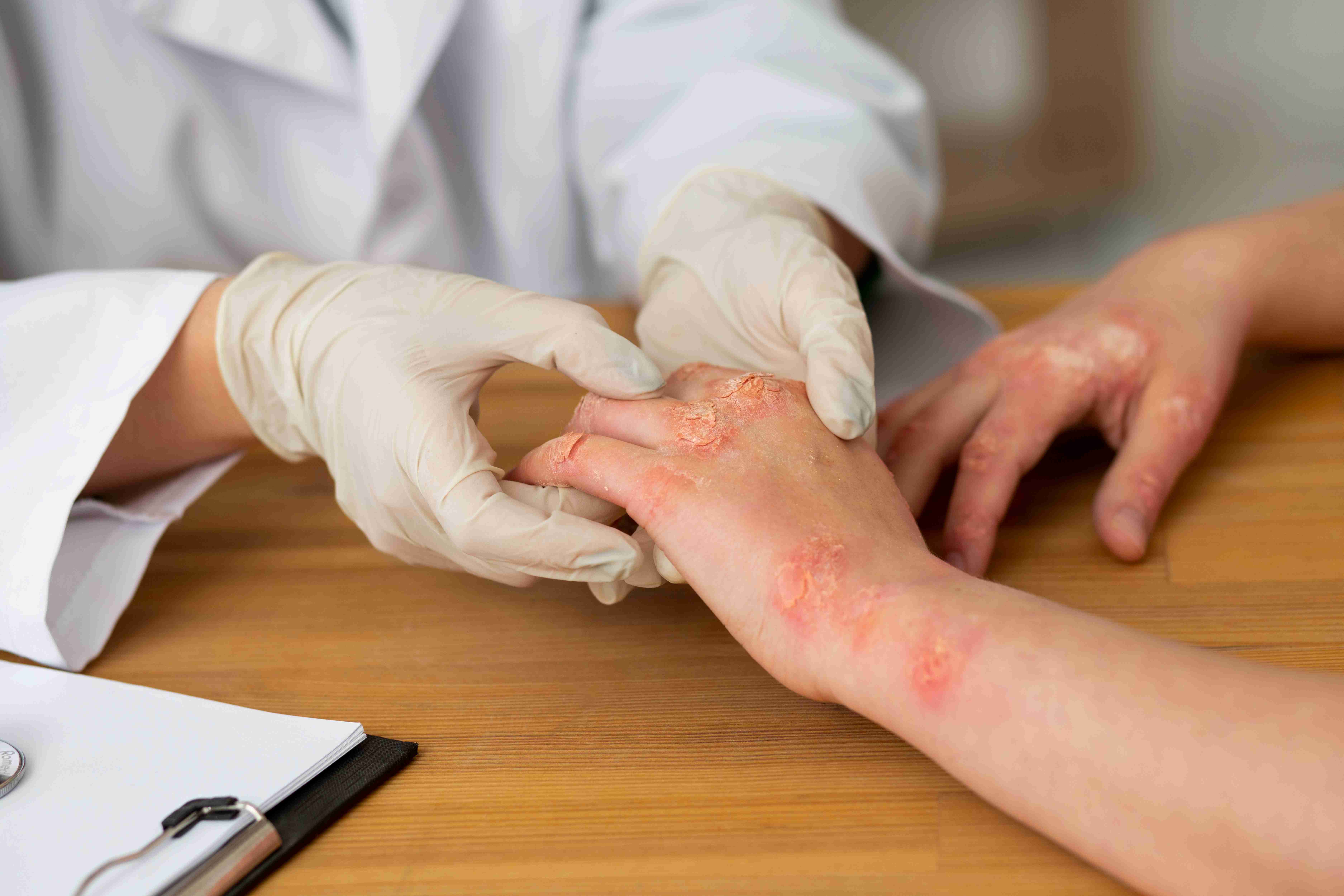Patchy dermatitis caused by metal allergy