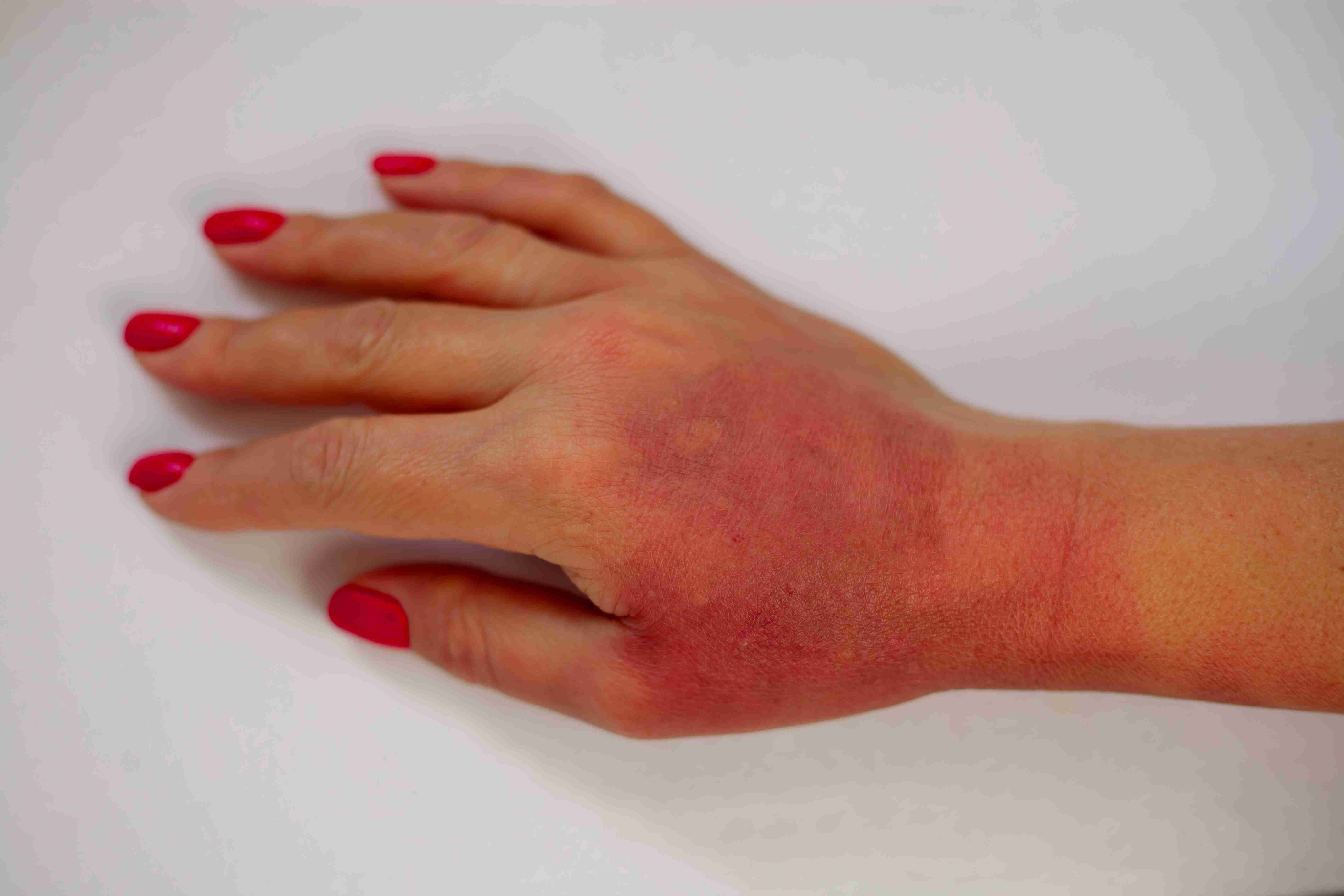 Contact dermatitis on hands from irritants
