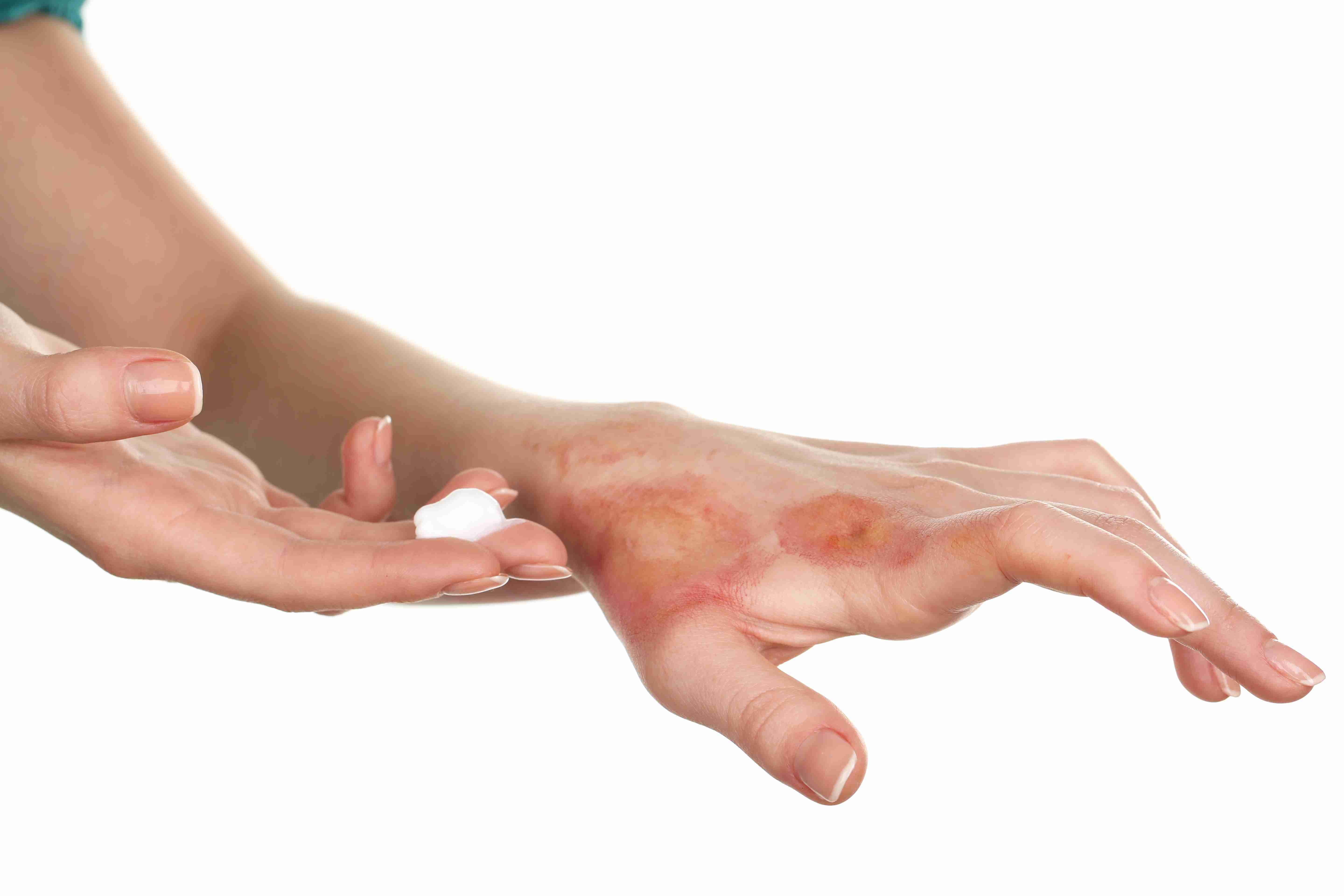 Steps for contact dermatitis care