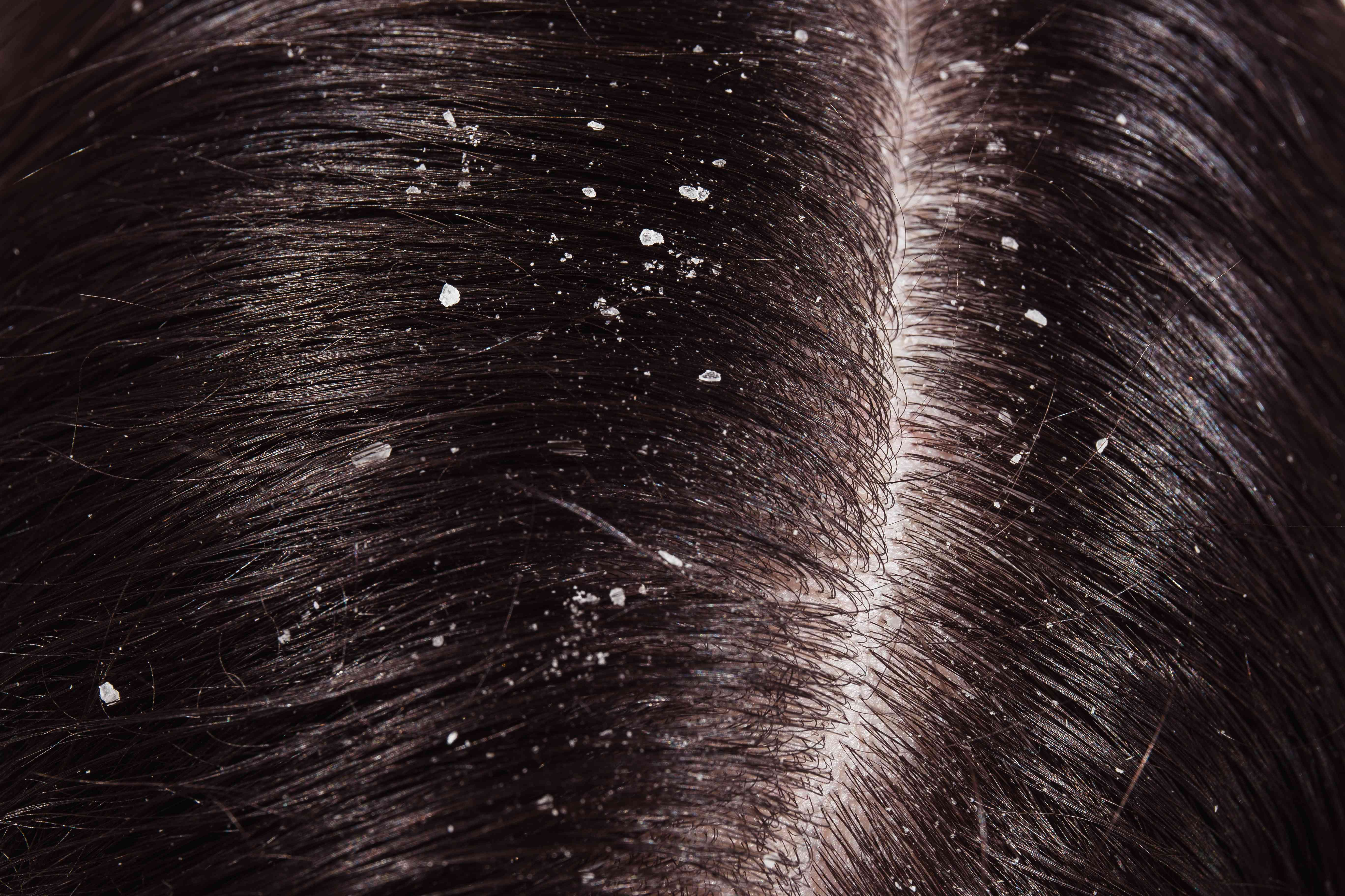 Flaky scalp with visible dandruff