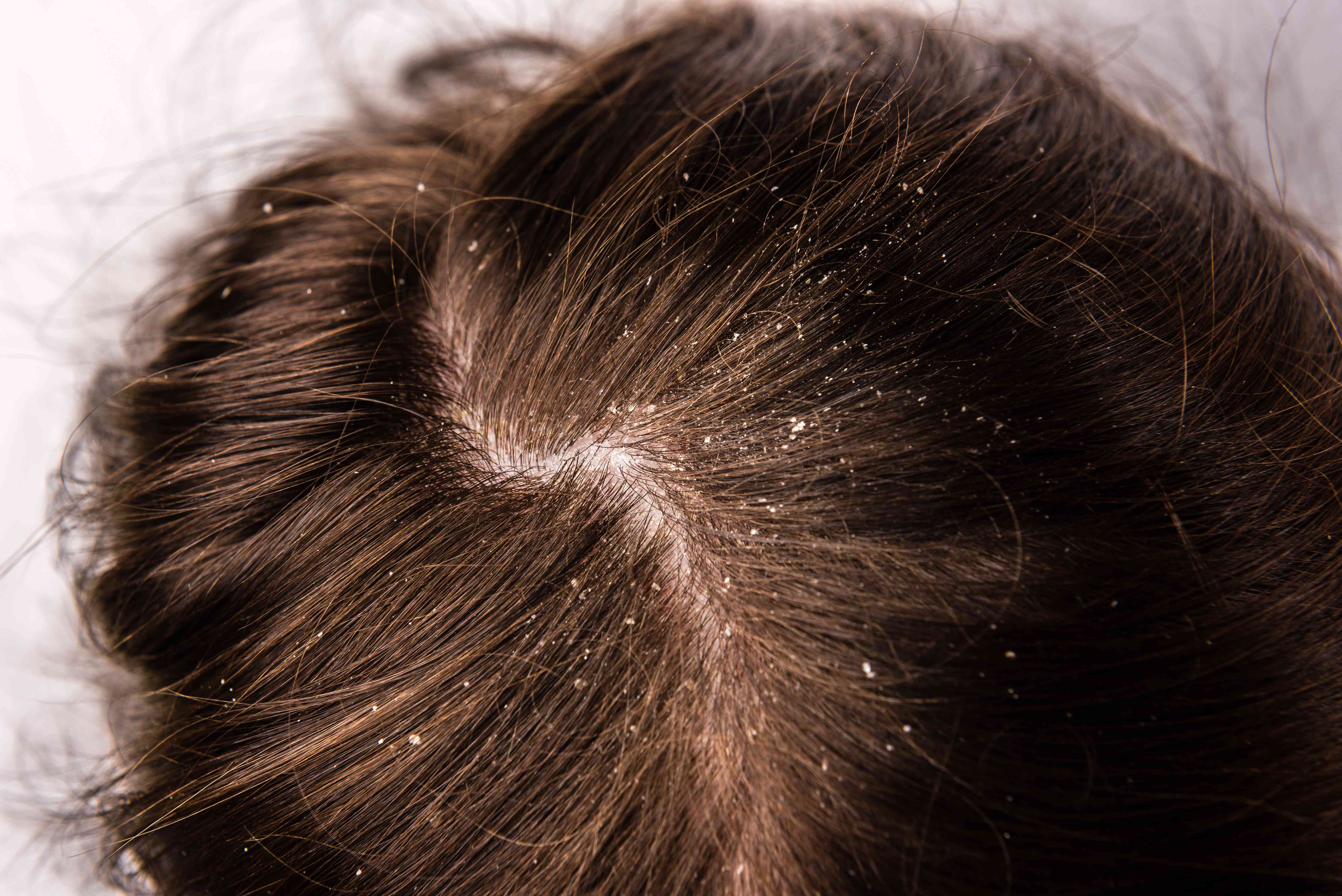 Close-up of dandruff flakes on scalp