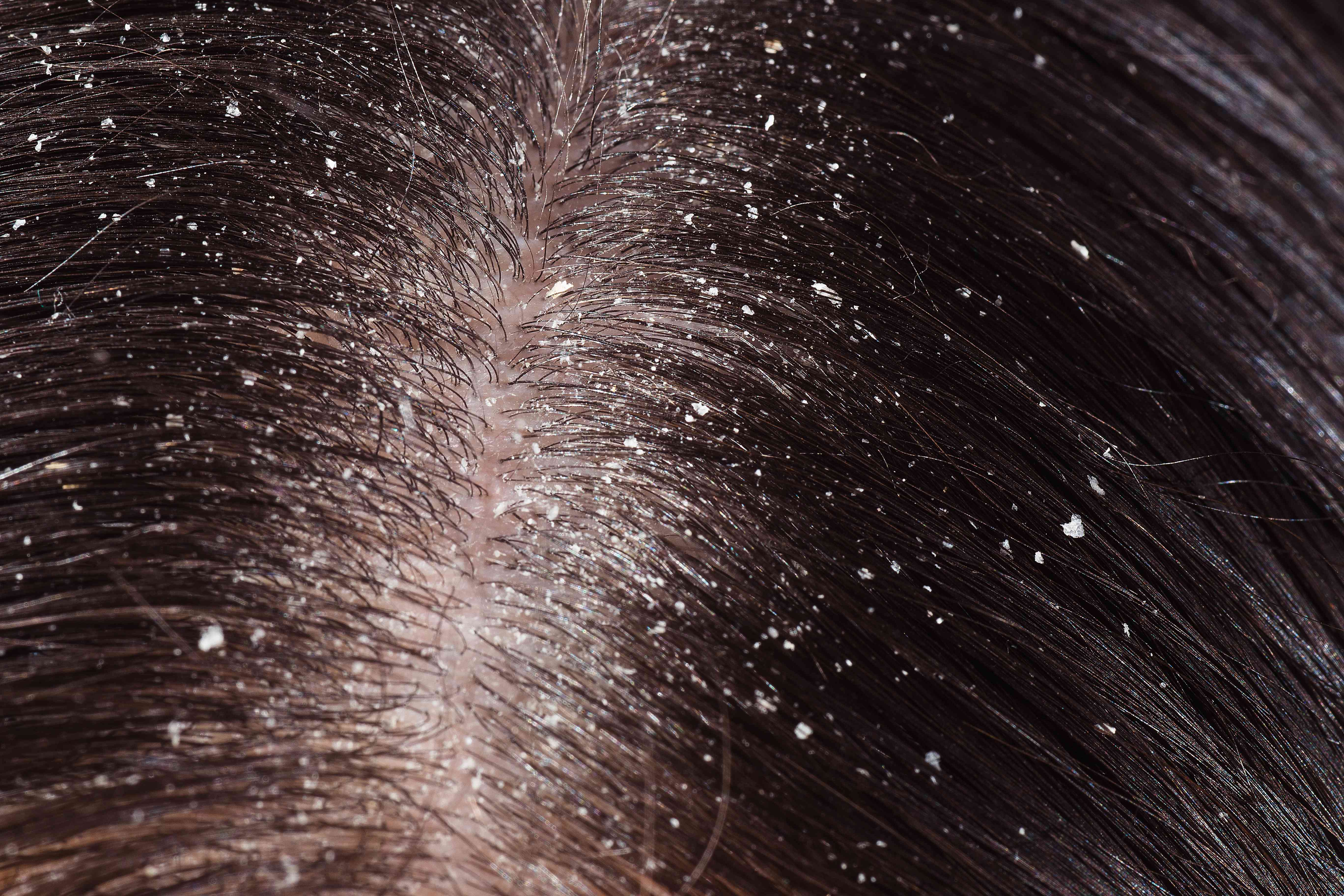 Severe scalp scaling with irritation