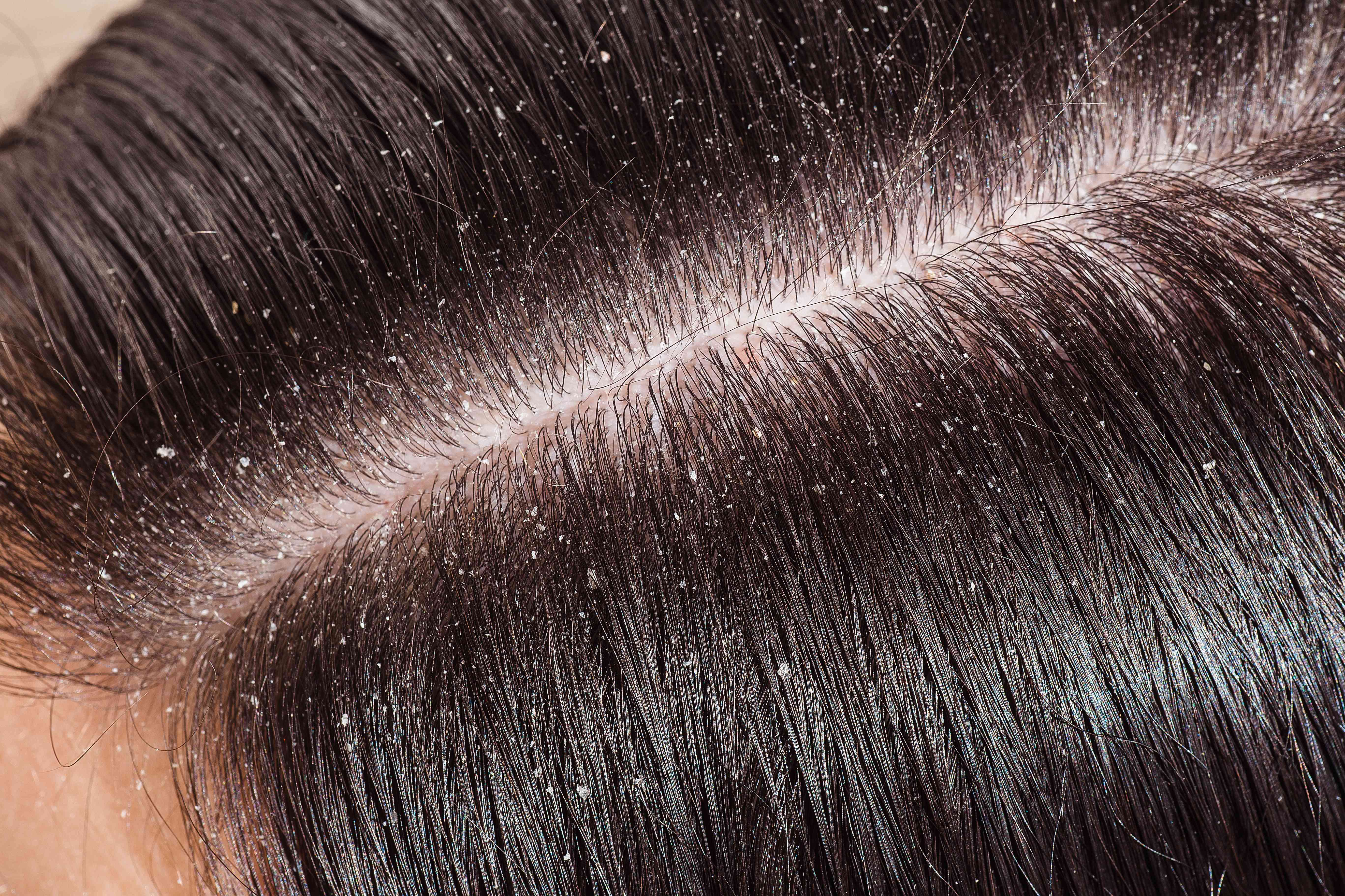 Application of medicated anti-dandruff shampoo