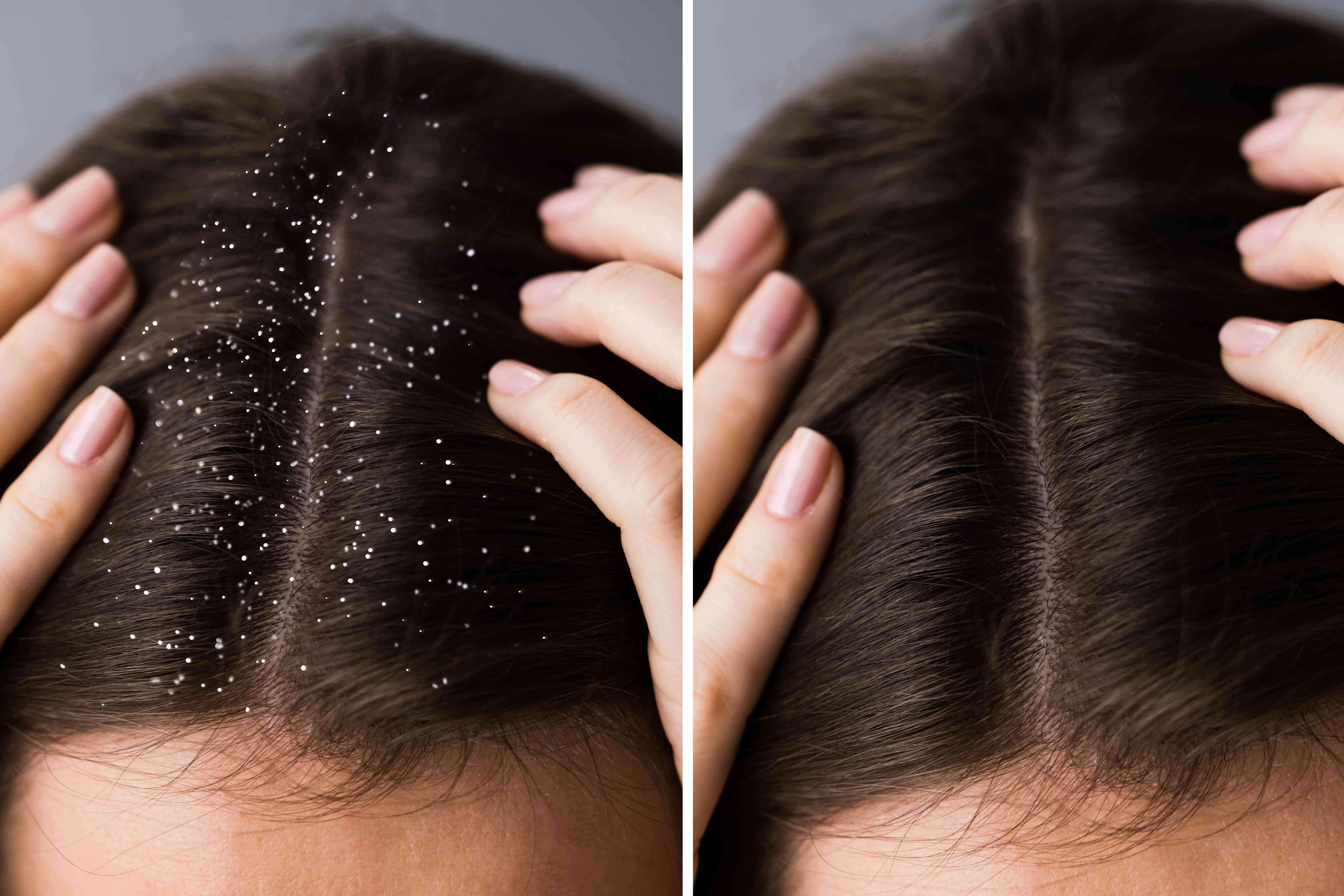 Dermatologist consultation for dandruff