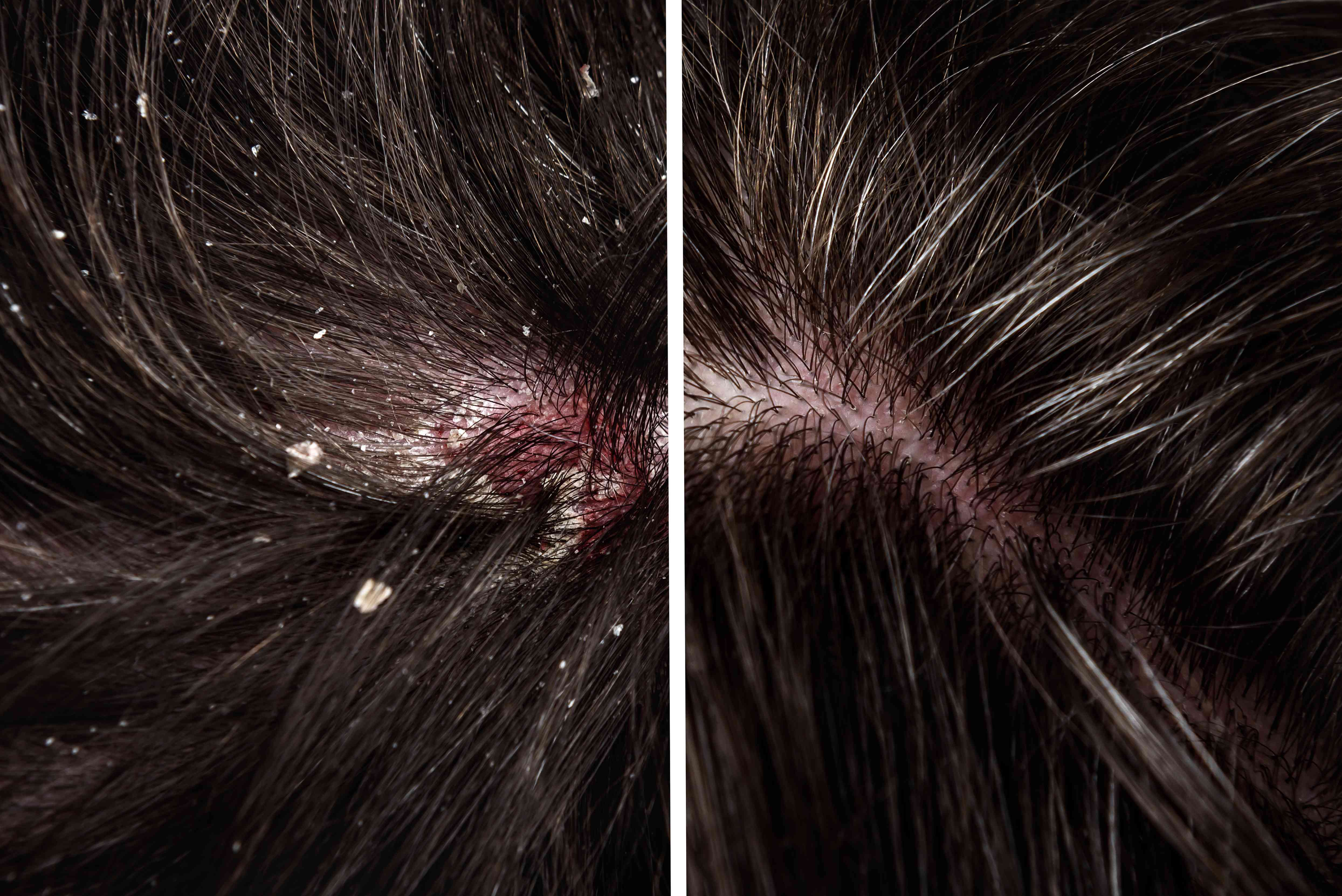 Before and after dandruff treatment