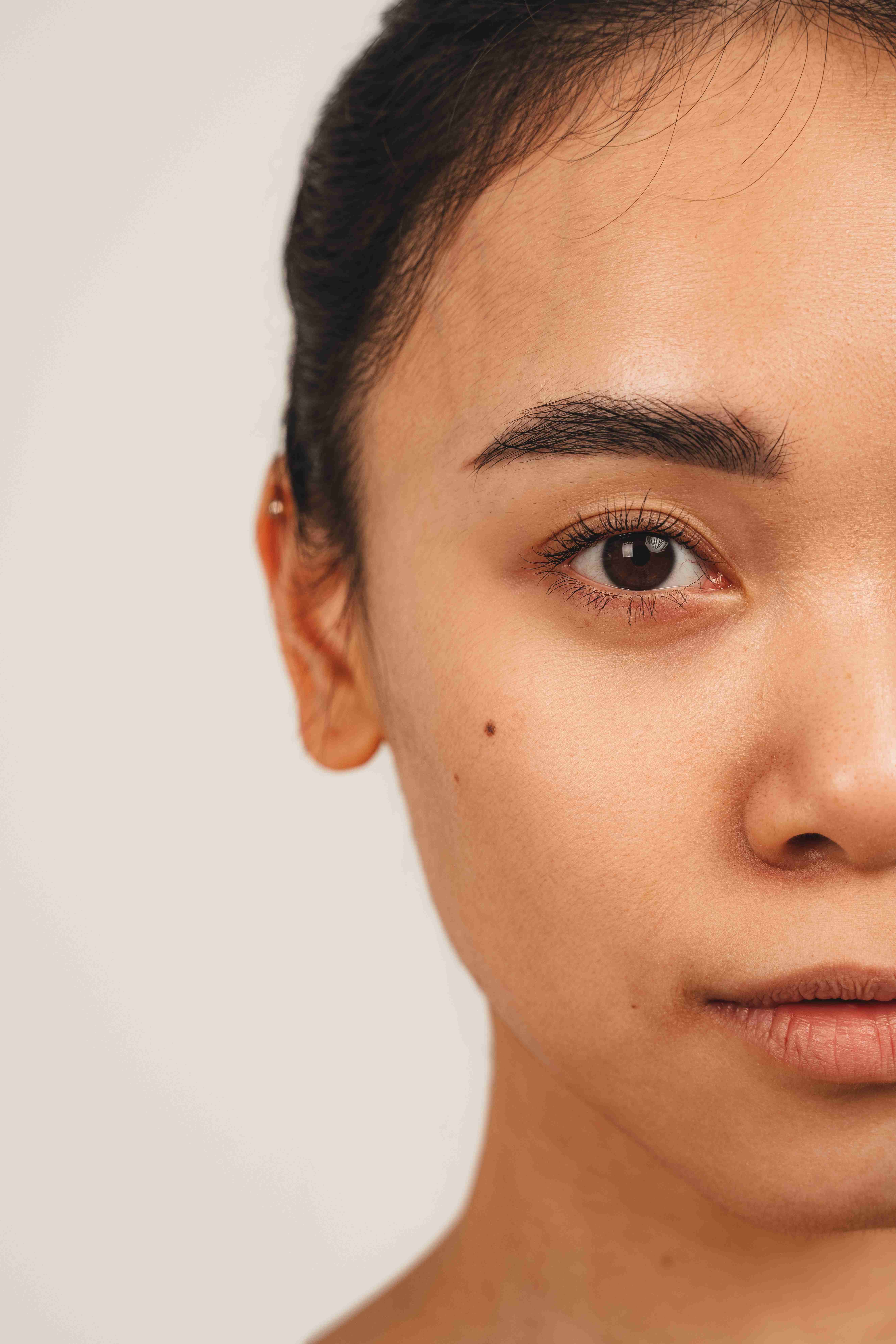Laser and filler treatments for dark circles