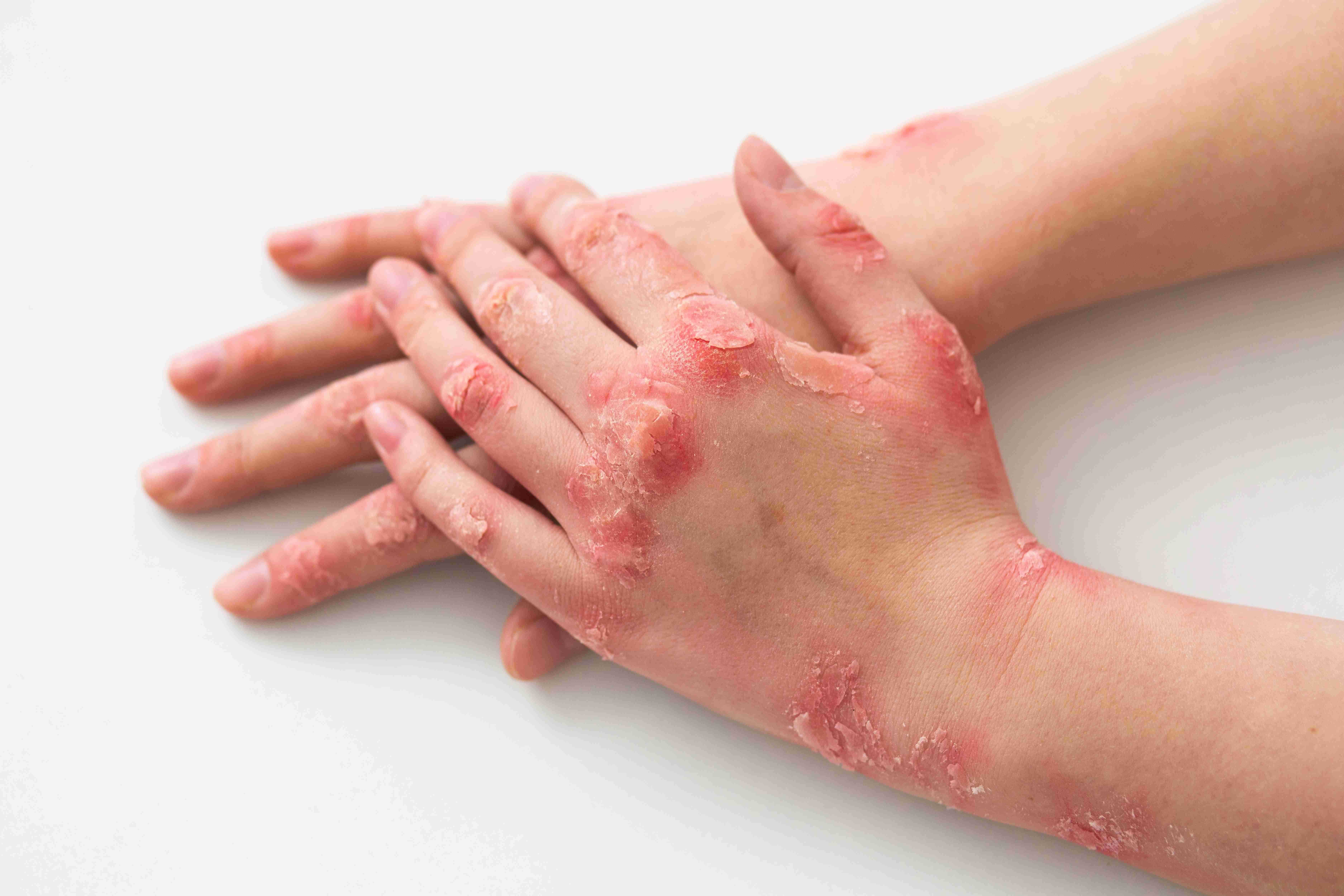 Dry itchy patches on arms due to eczema