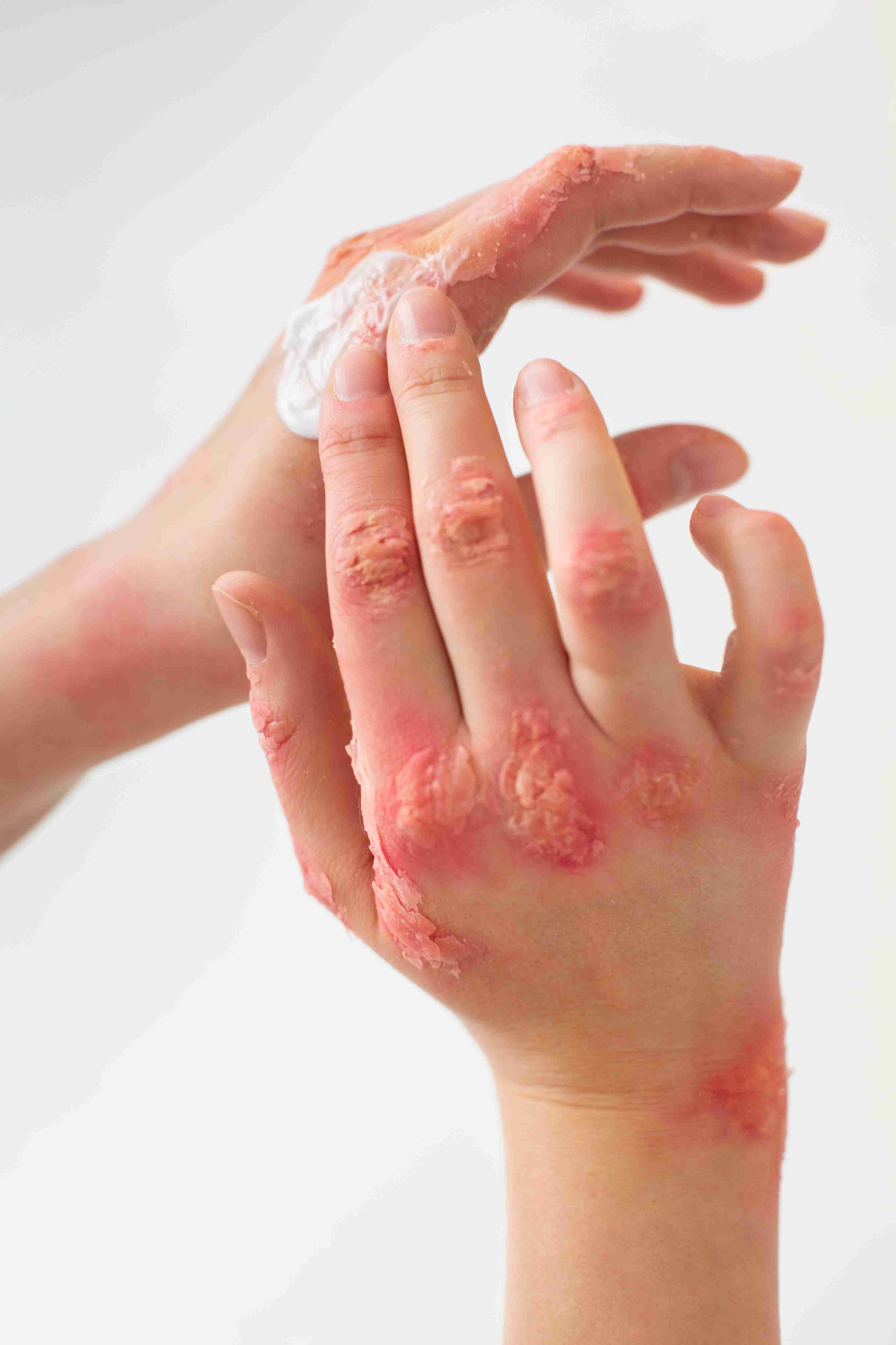 Dry, cracked eczema skin on legs
