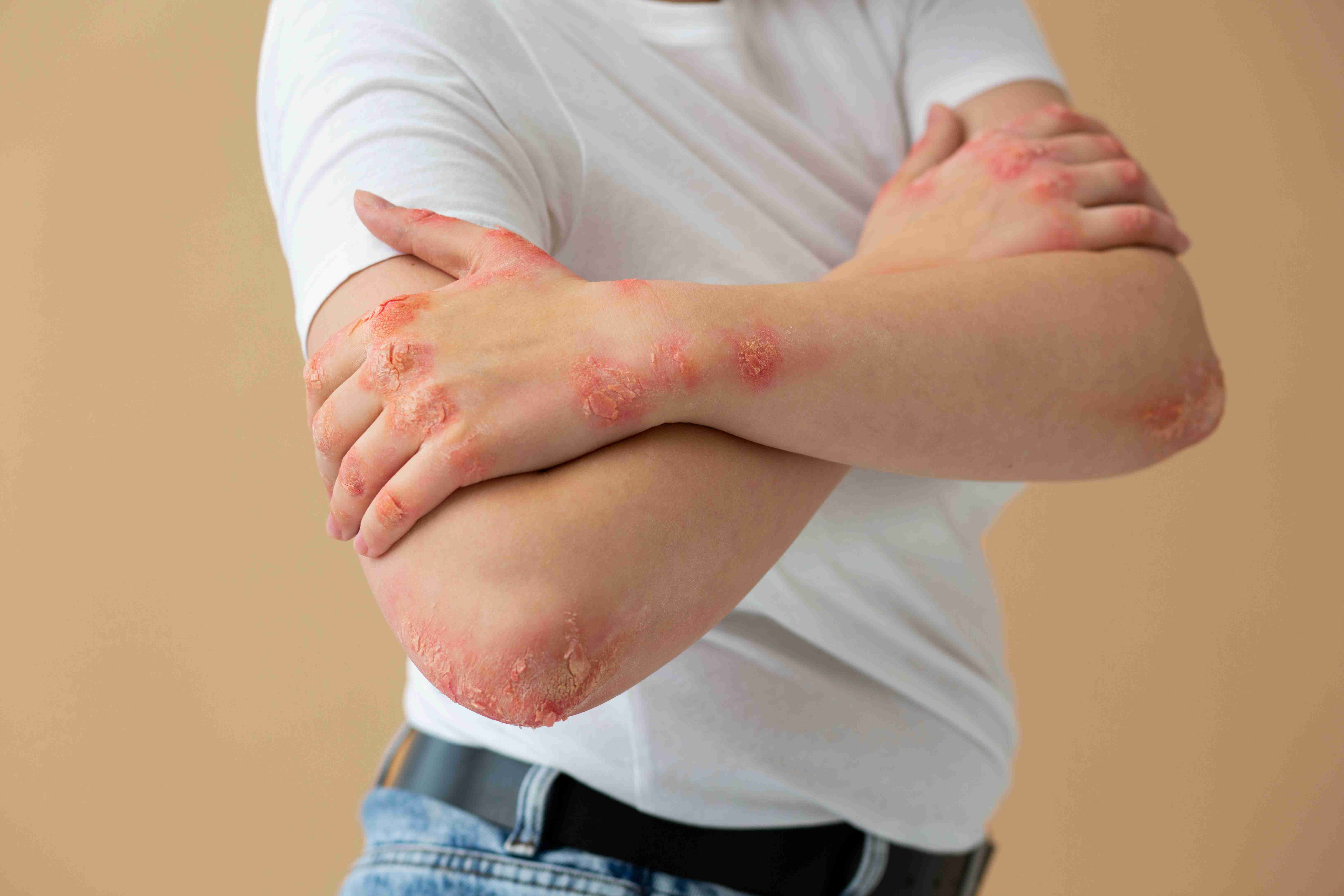 Eczema inflammation on hand and wrist