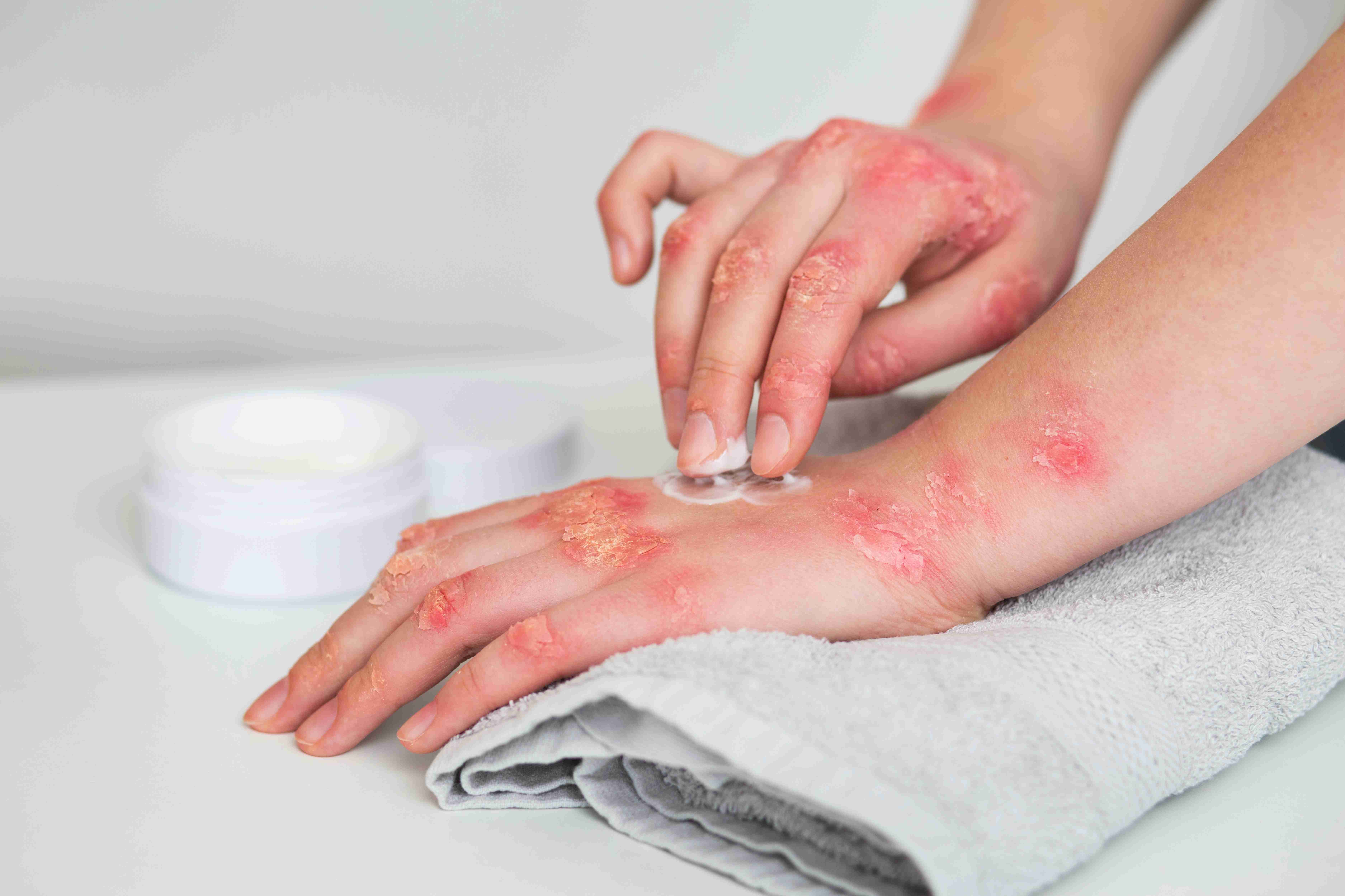 Applying topical cream to soothe eczema