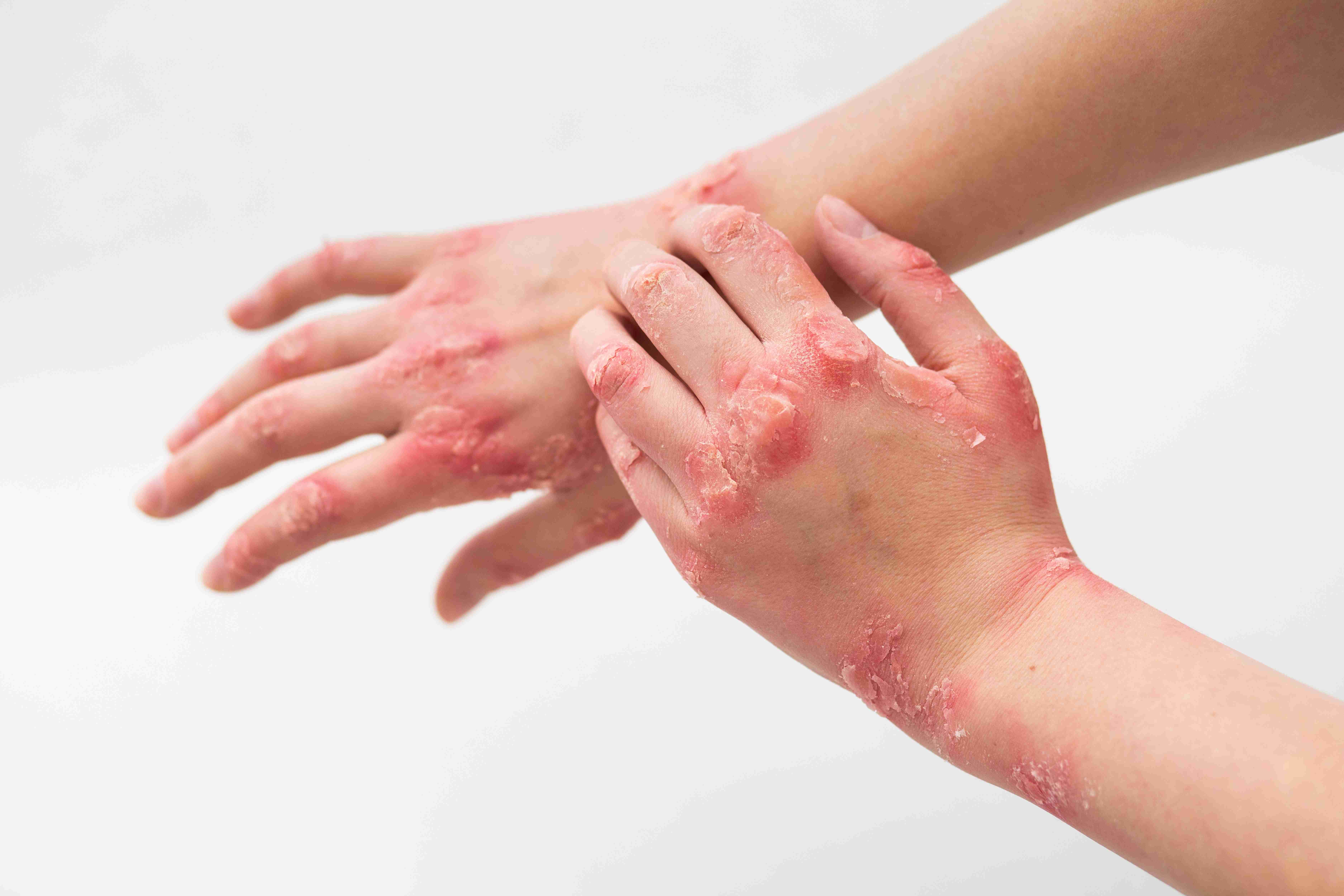 Eczema on the back of the hand