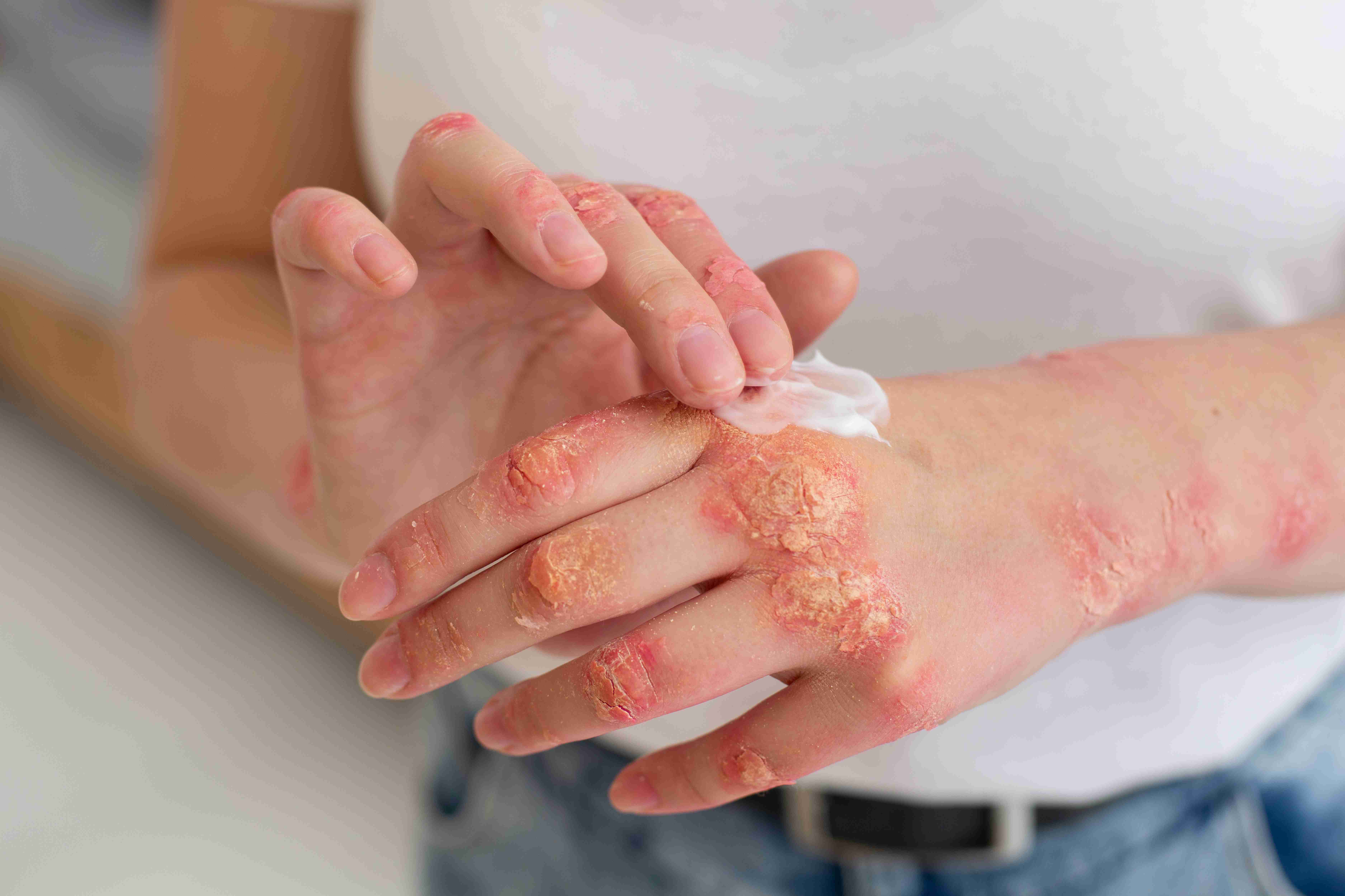 Eczema diagnosis and treatment flow