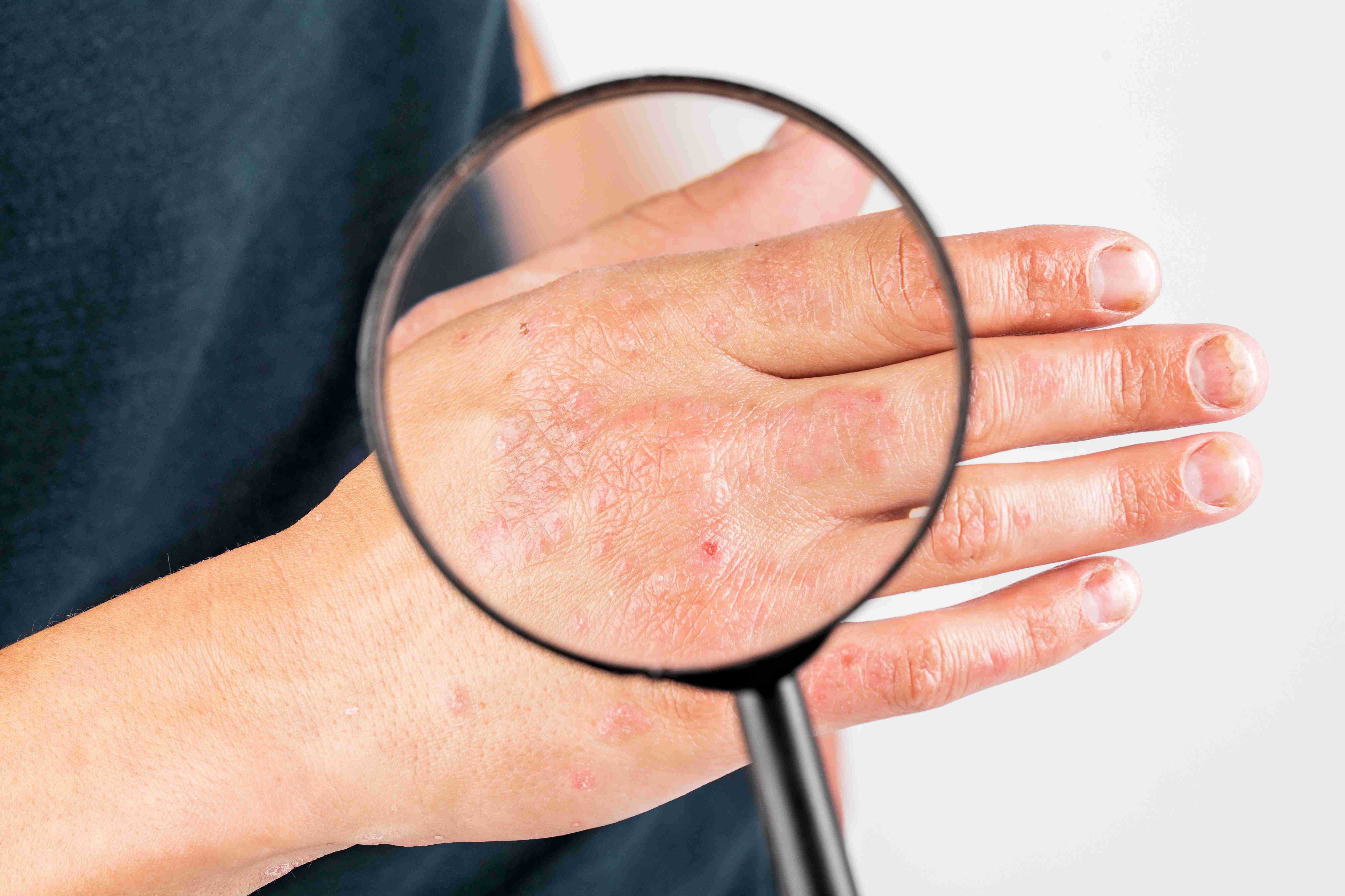 Before and after eczema treatment
