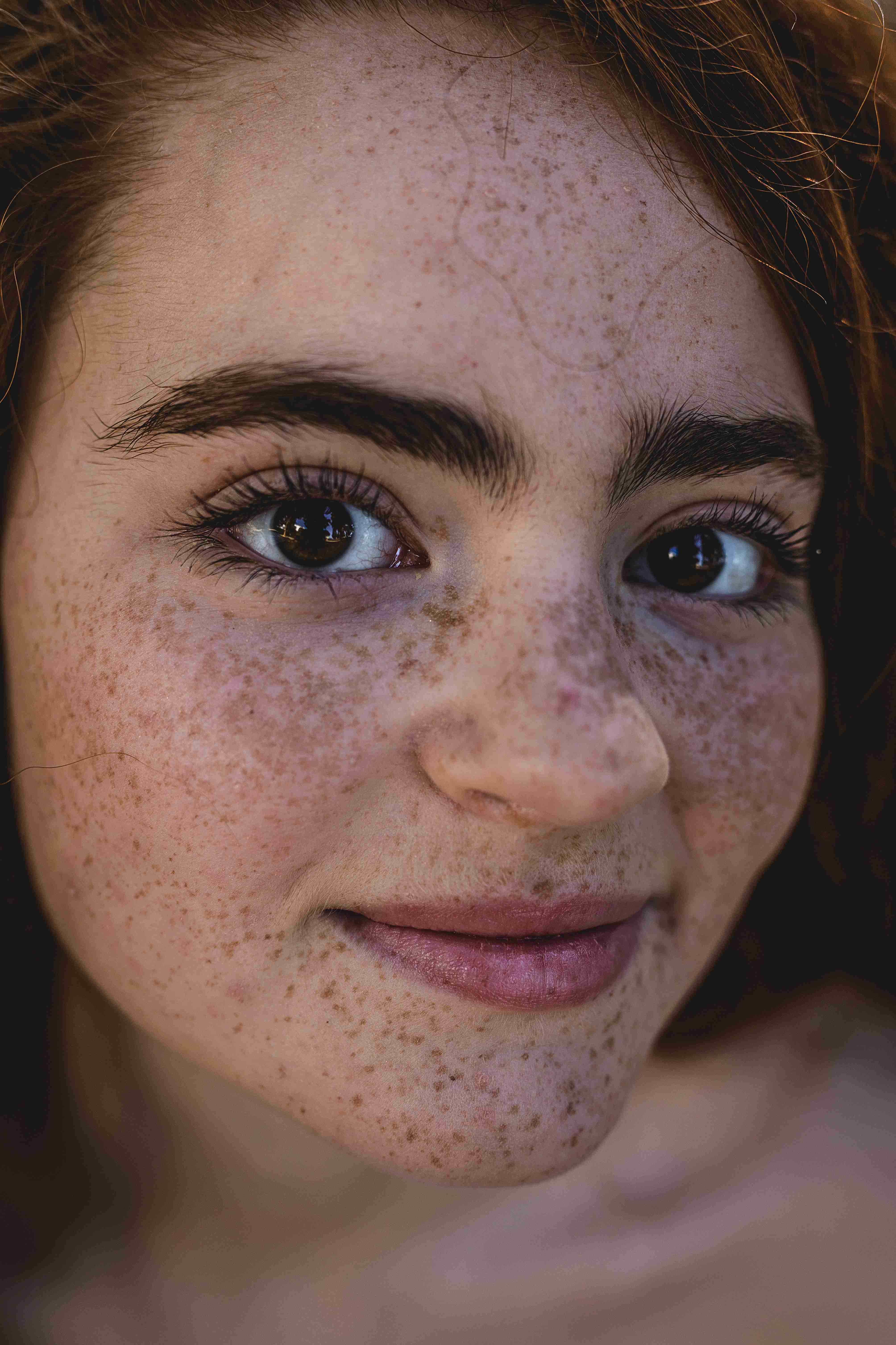 Freckles on cheeks and nose