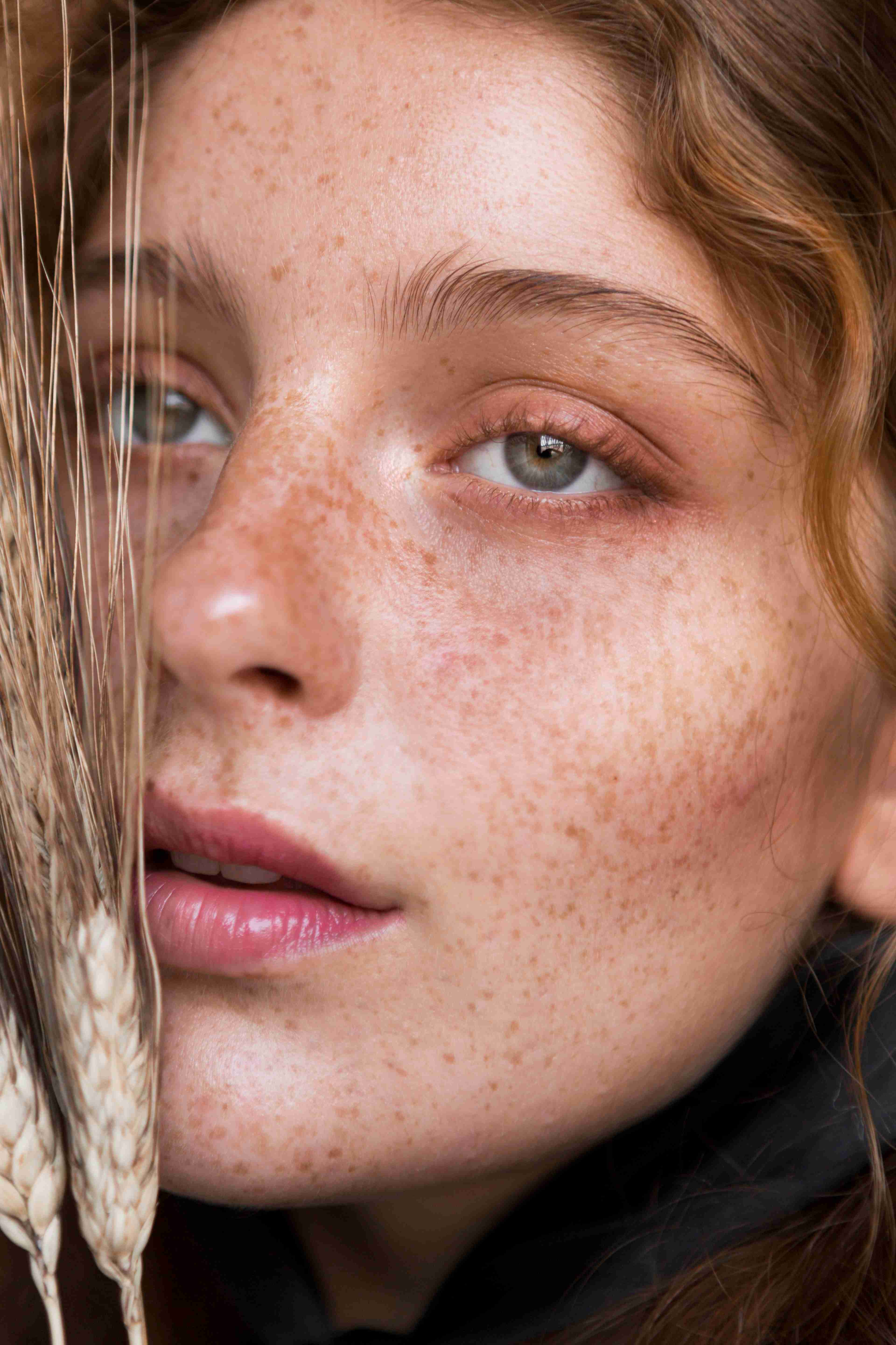 UV exposure causing freckles