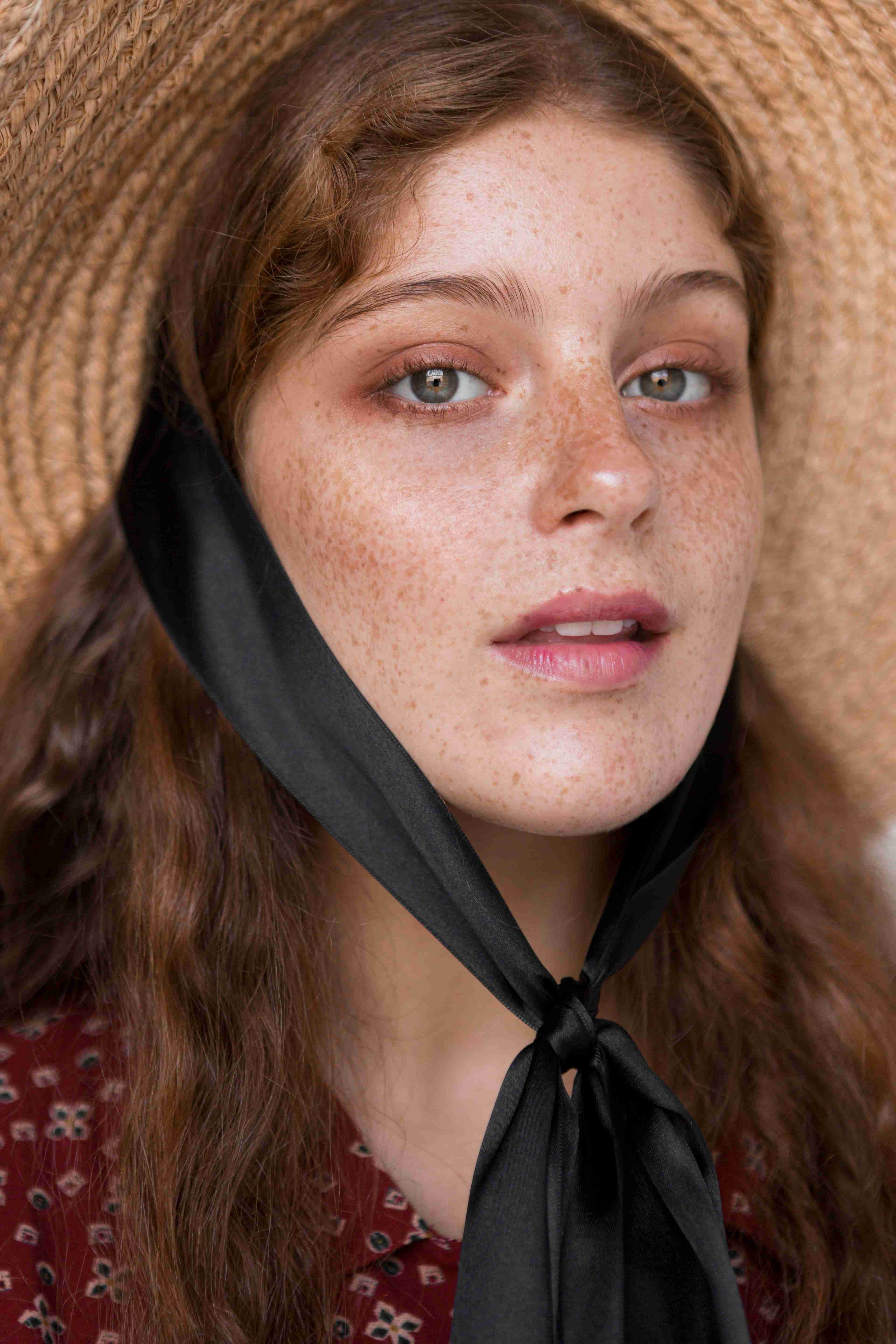 Before and after freckle treatment