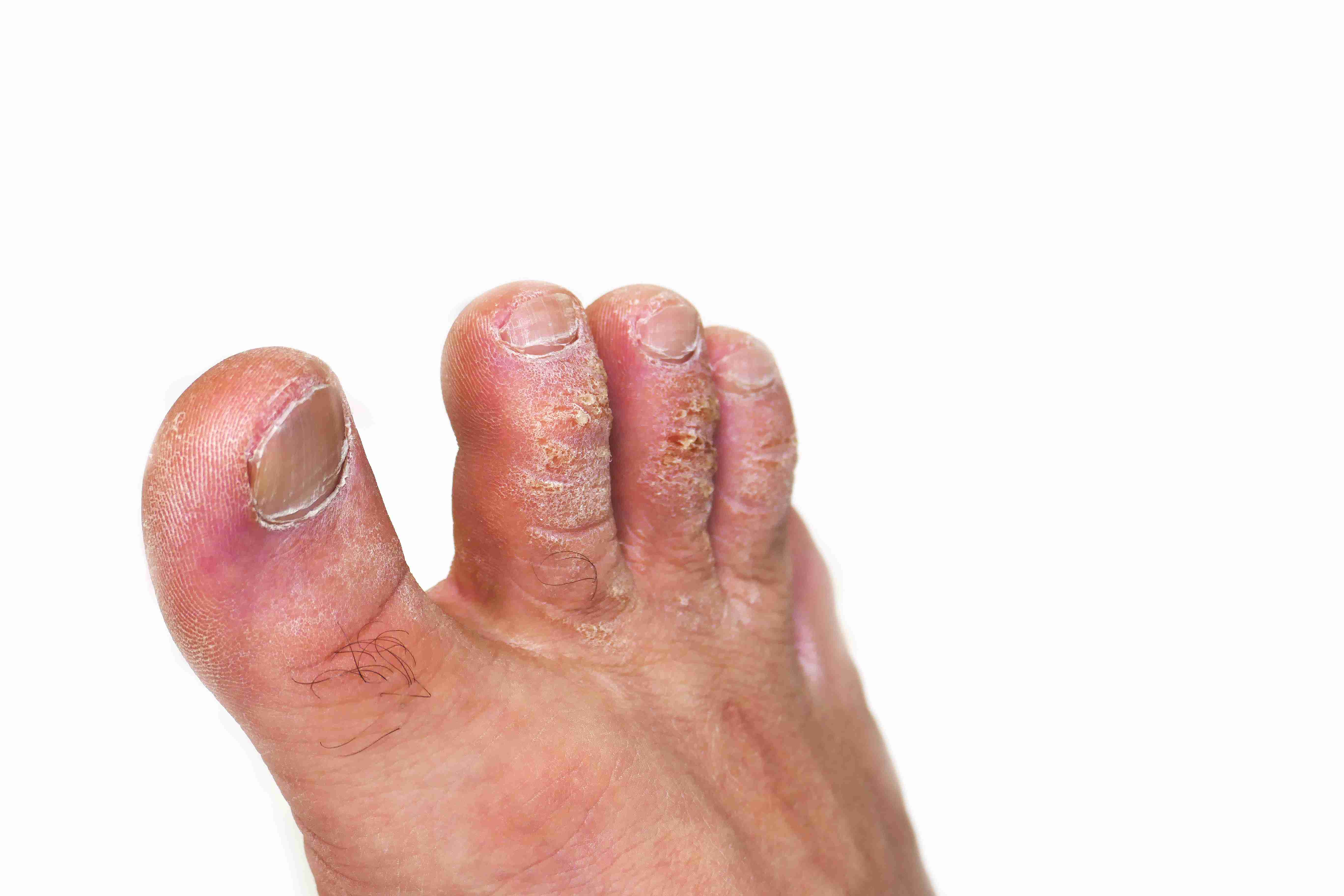 Fungal Infection