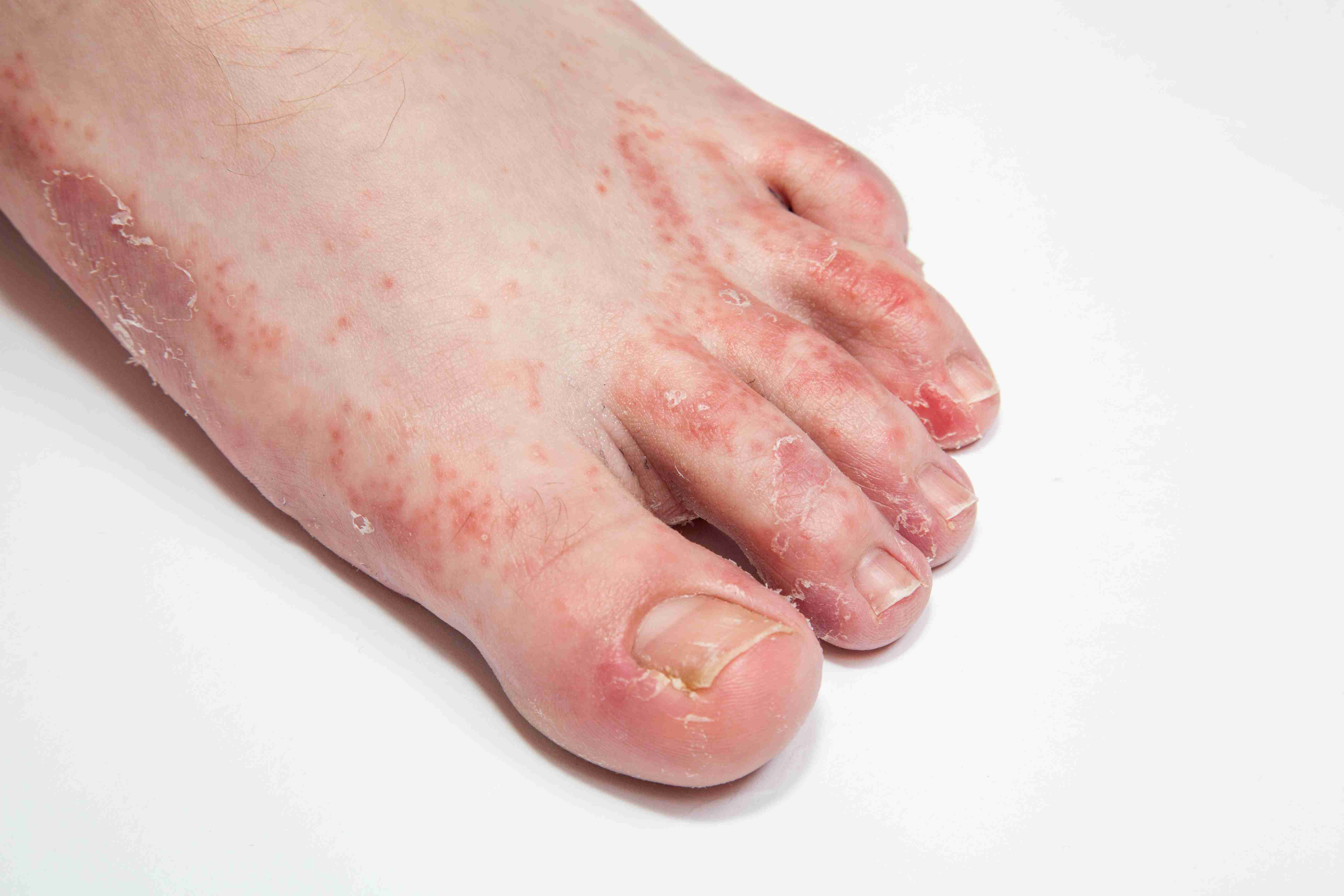 Red itchy patch caused by fungal infection