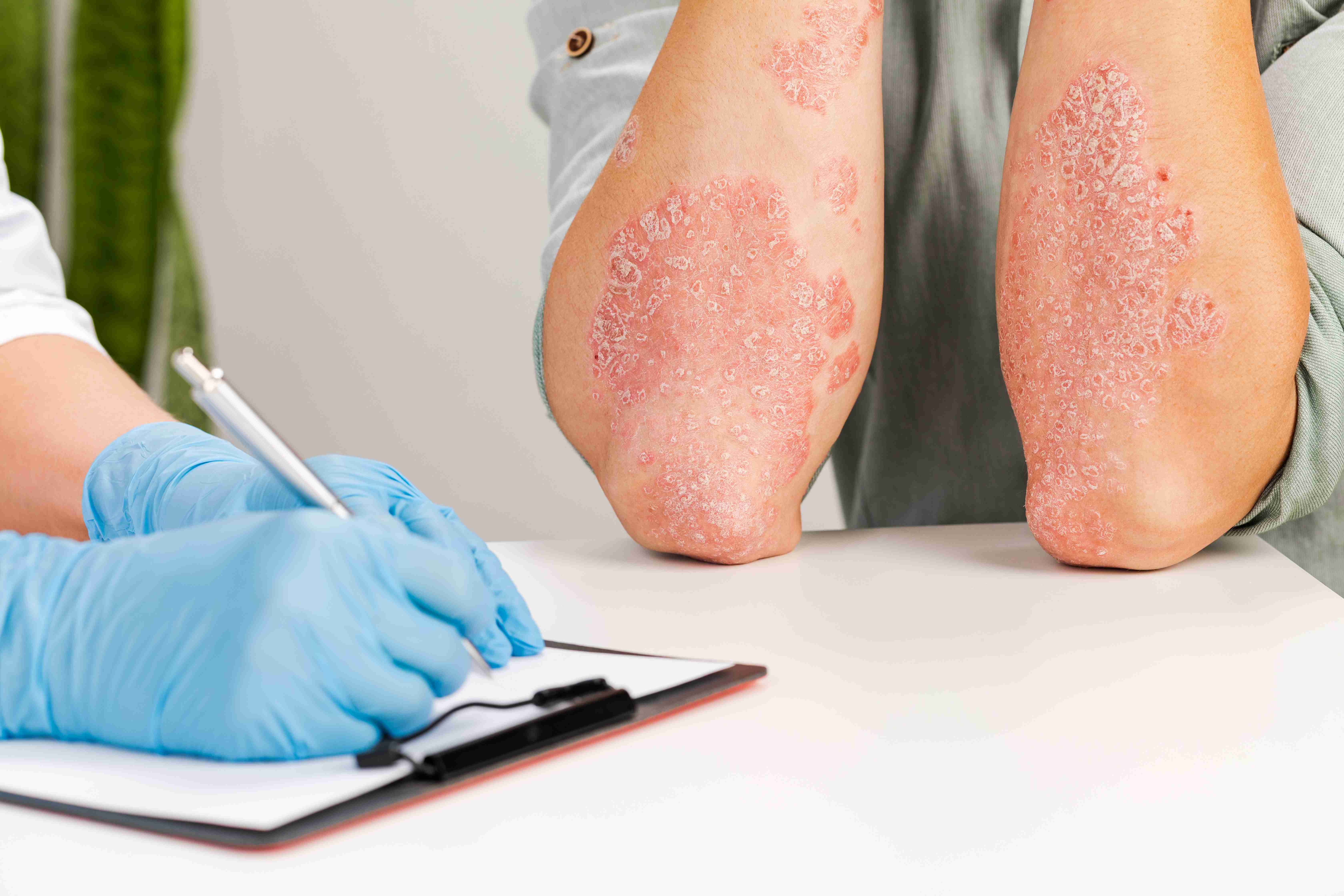 Fungal infection types explained