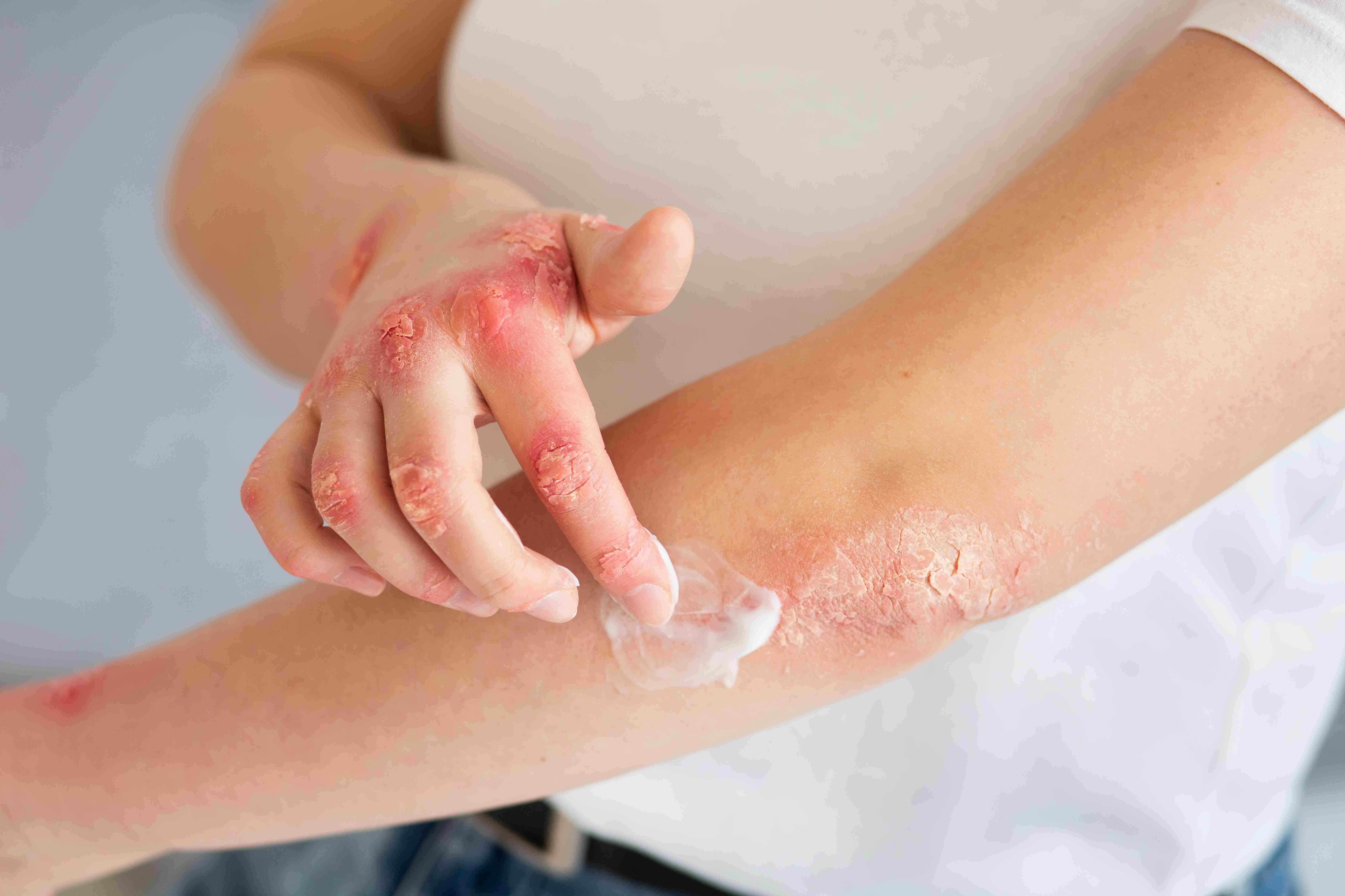 Topical antifungal treatment
