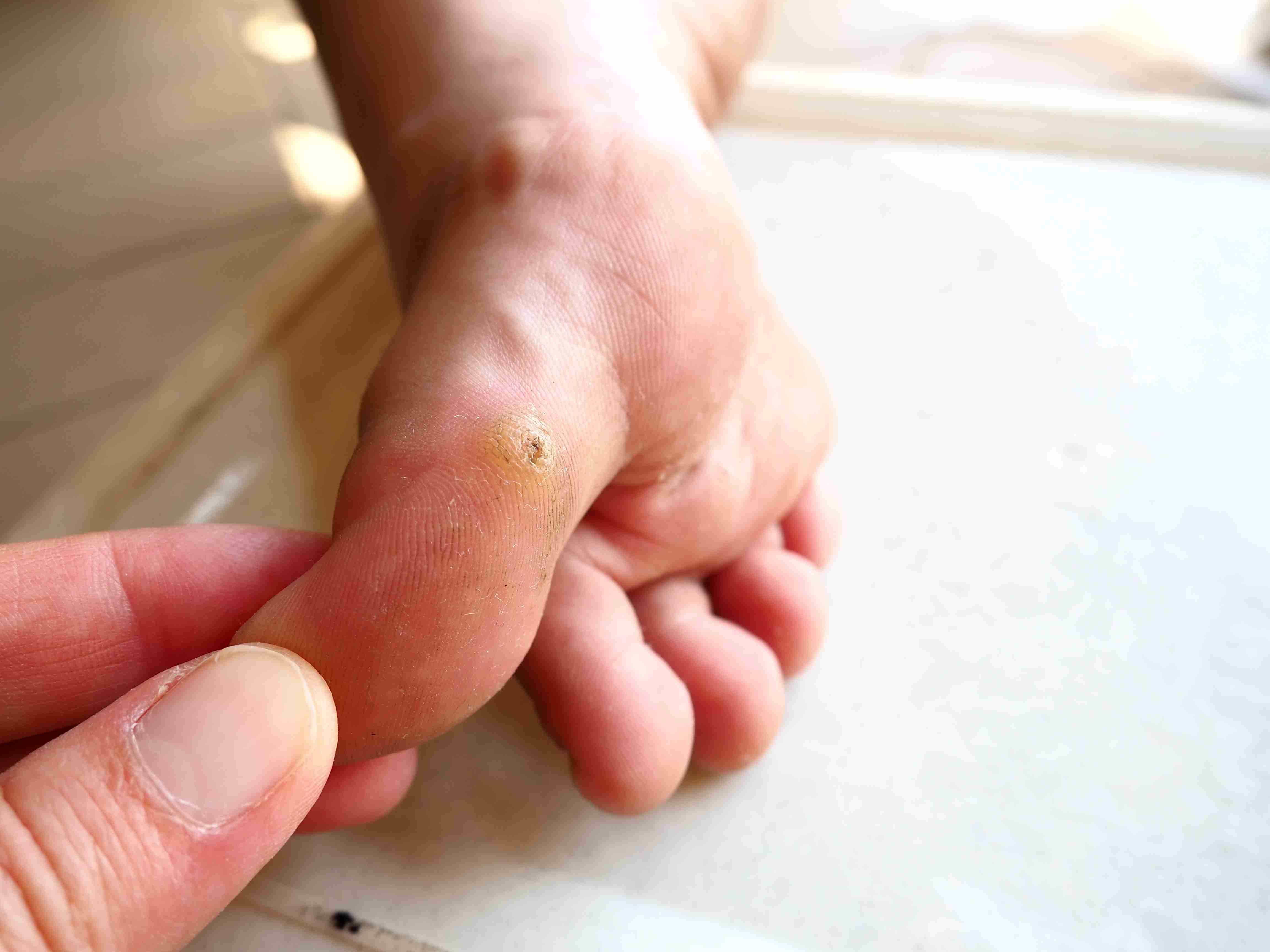 Steps to treat fungal infections
