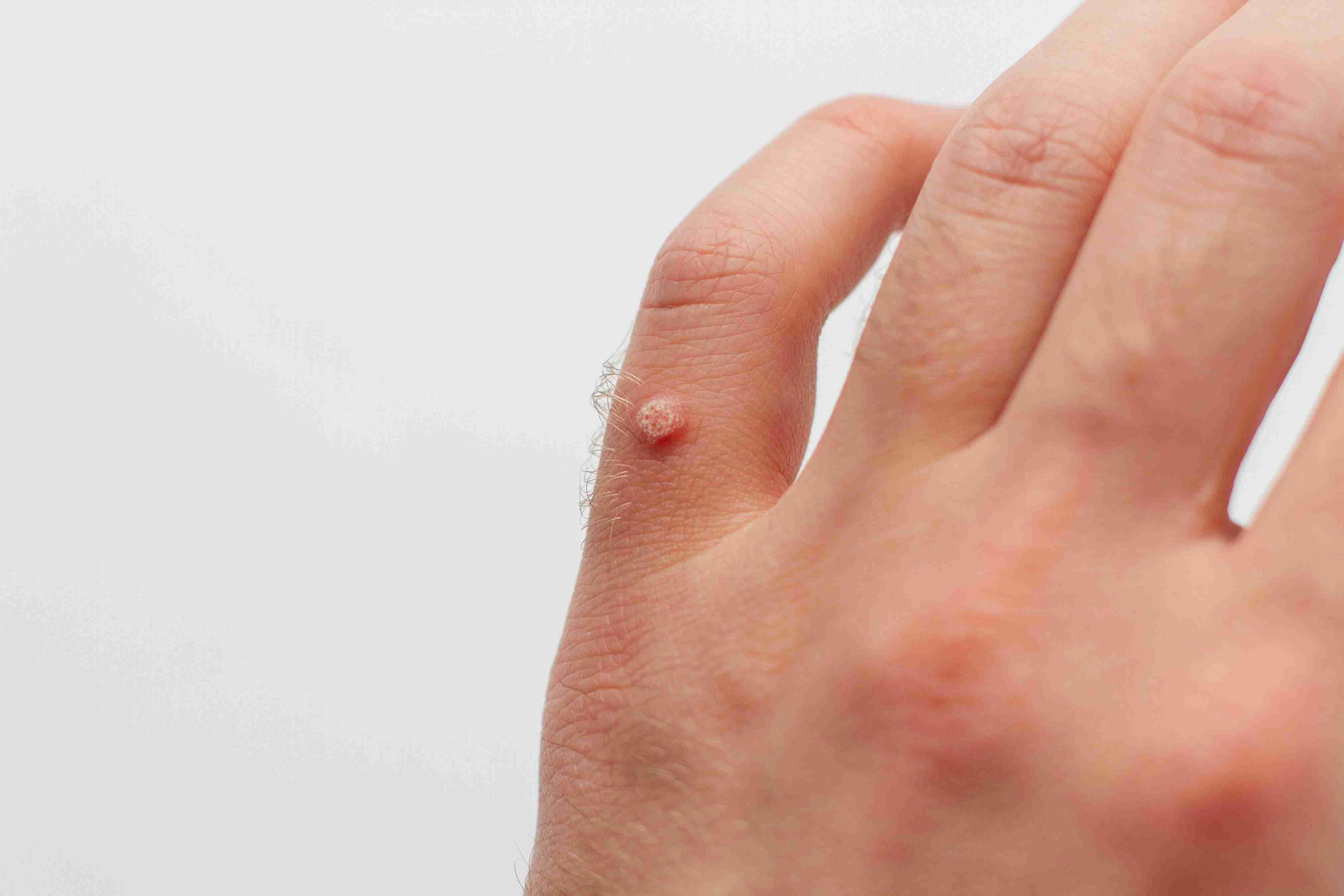 Fungal infection treatment results