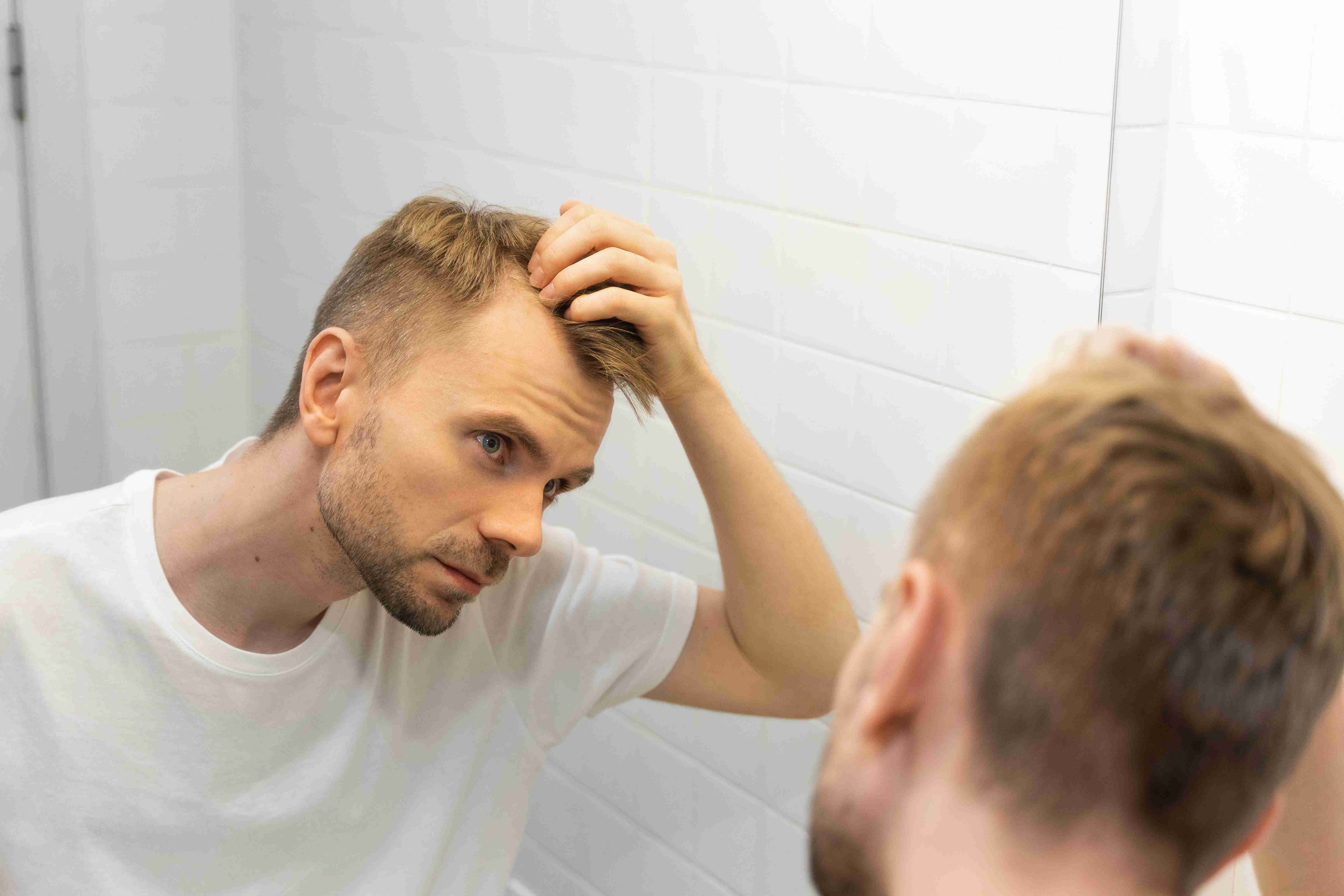 Genetic and hormonal causes of male hairfall