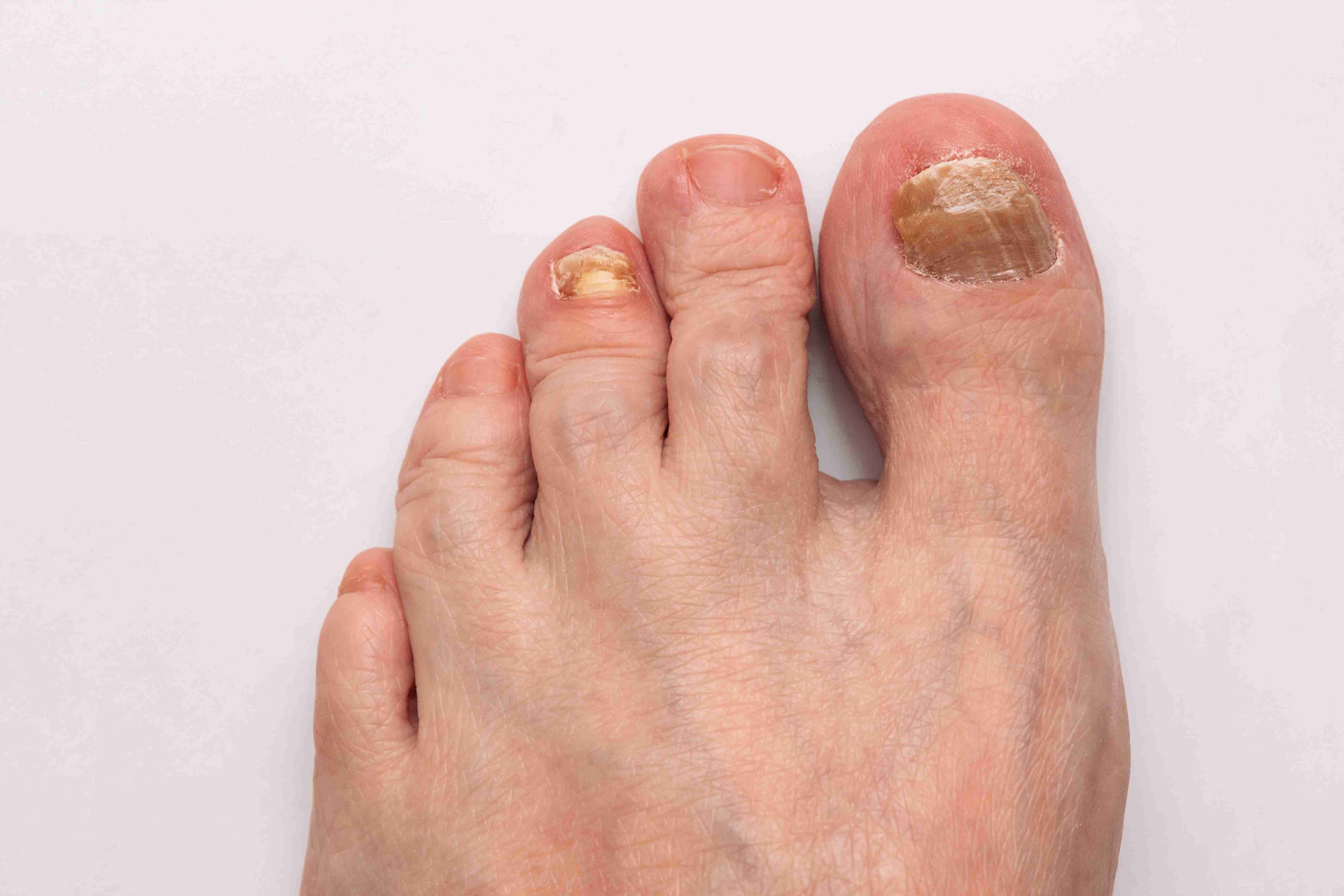 Red and swollen toe with ingrown nail