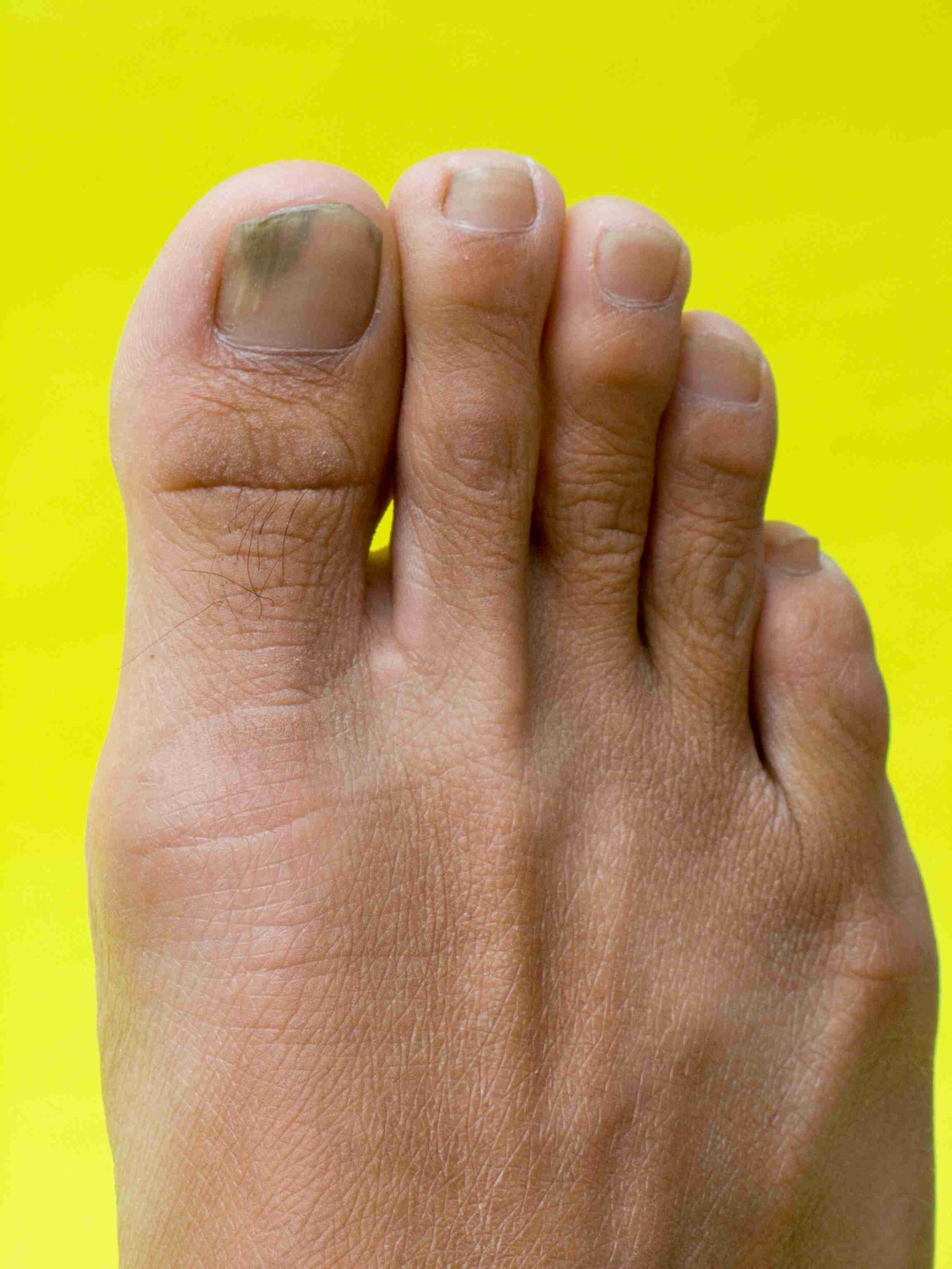 Factors contributing to ingrown nails