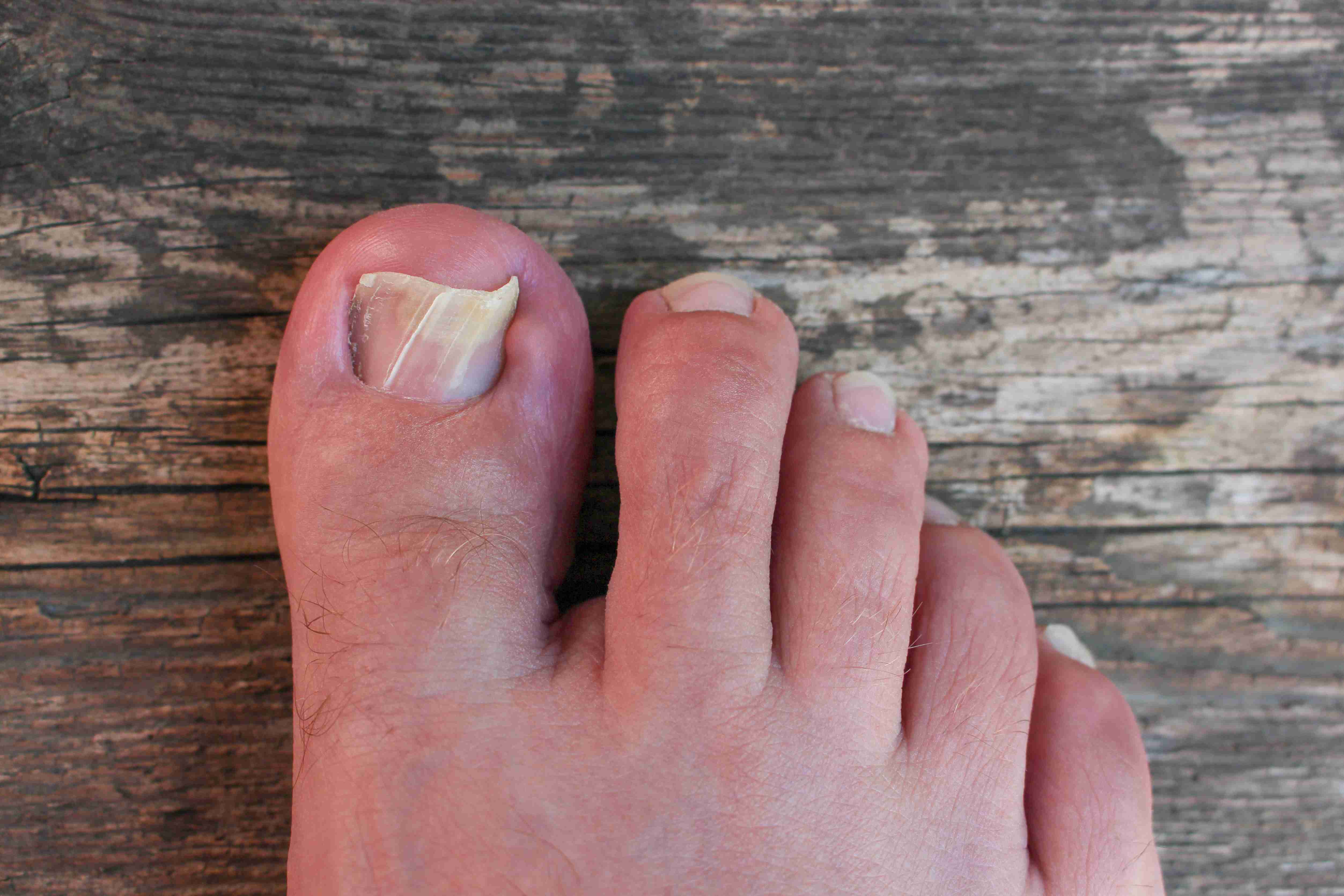 Painful inflamed toenail with infection
