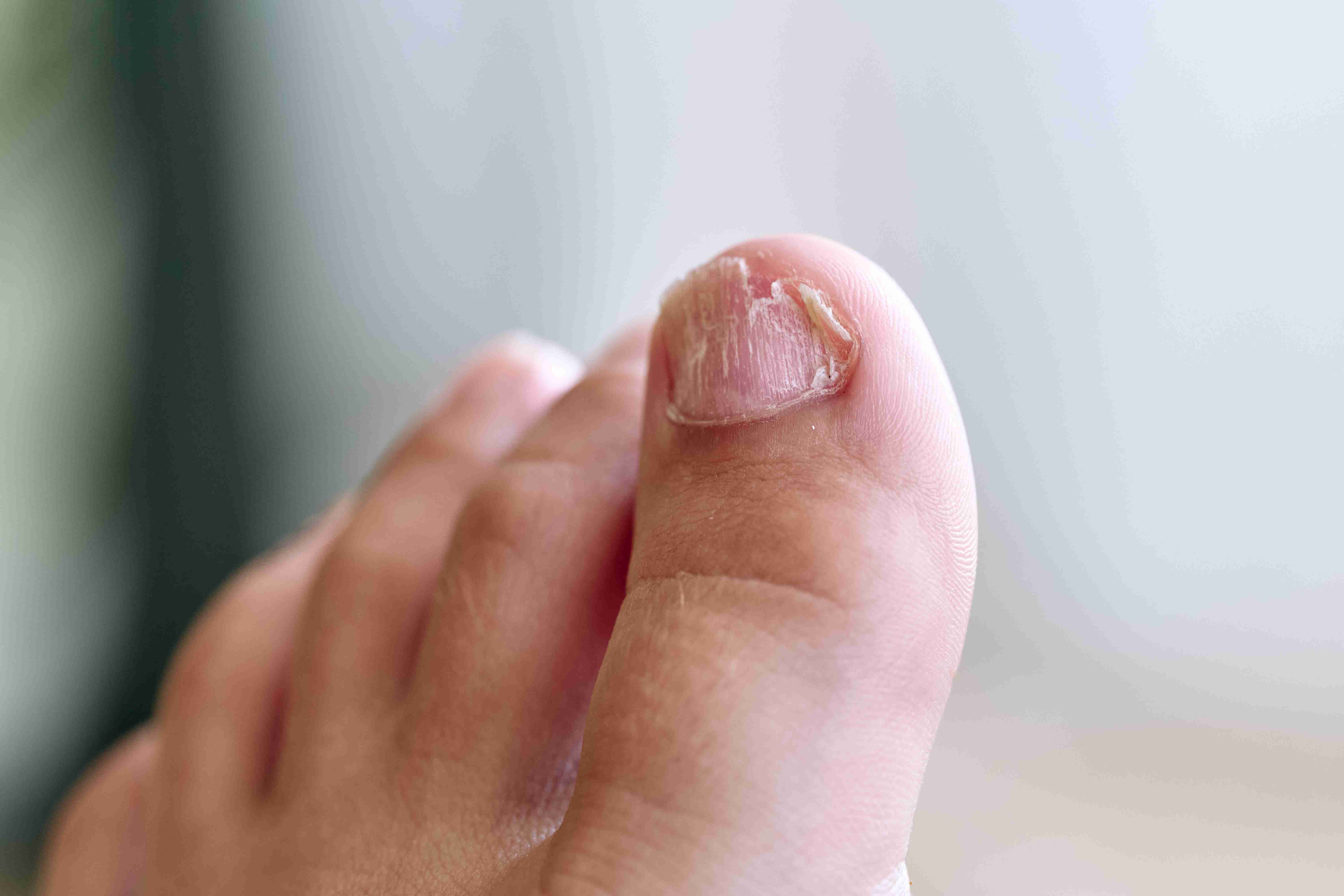 Partial nail removal treatment for ingrown nails